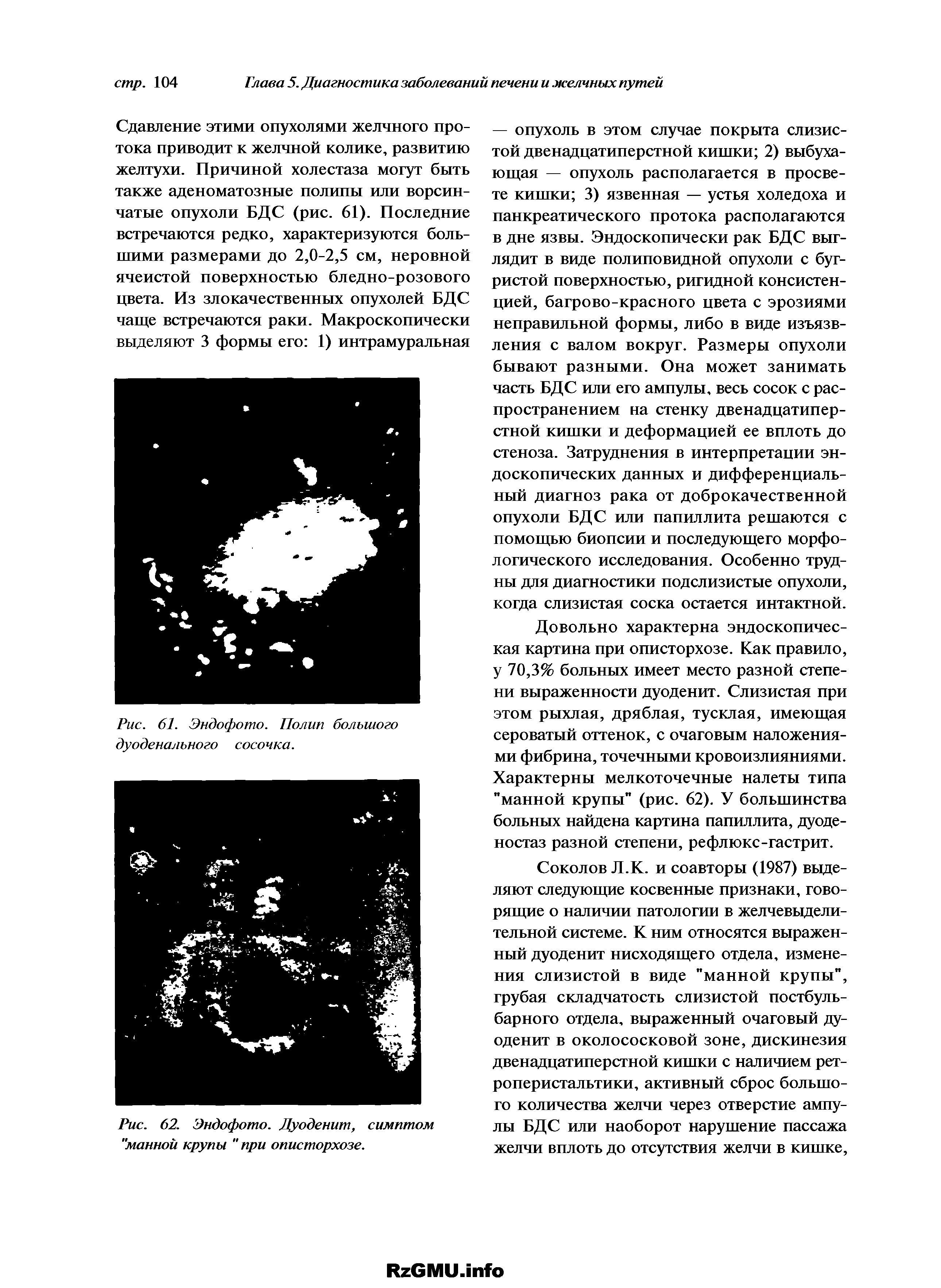 Рис. 62. Эндофото. Дуоденит, симптом "манной крупы "при описторхозе.