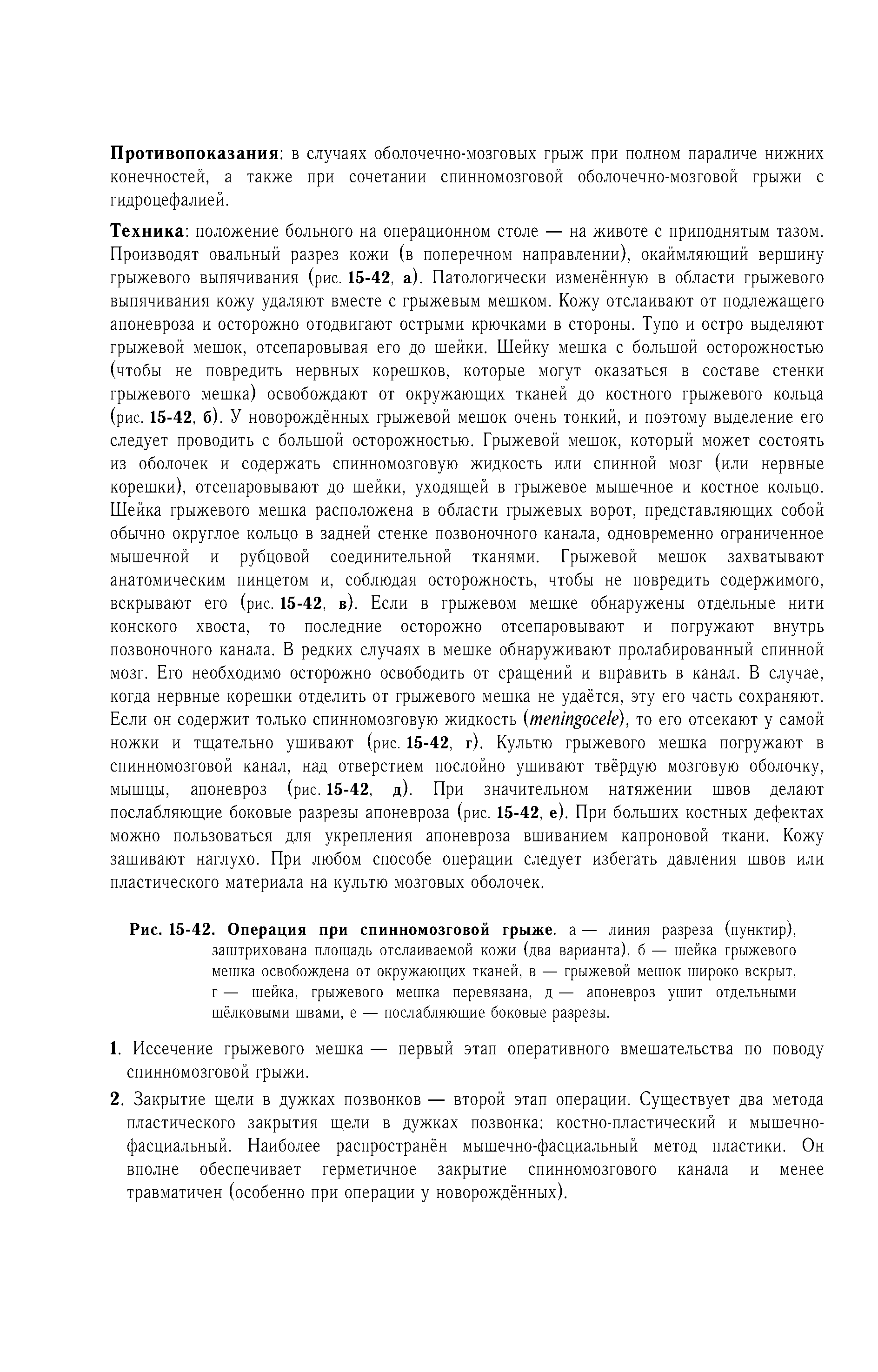 Рис. 15-42. Операция при спинномозговой грыже, а — линия разреза (пунктир), заштрихована площадь отслаиваемой кожи (два варианта), б — шейка грыжевого мешка освобождена от окружающих тканей, в — грыжевой мешок широко вскрыт, г — шейка, грыжевого мешка перевязана, д — апоневроз ушит отдельными шёлковыми швами, е — послабляющие боковые разрезы.