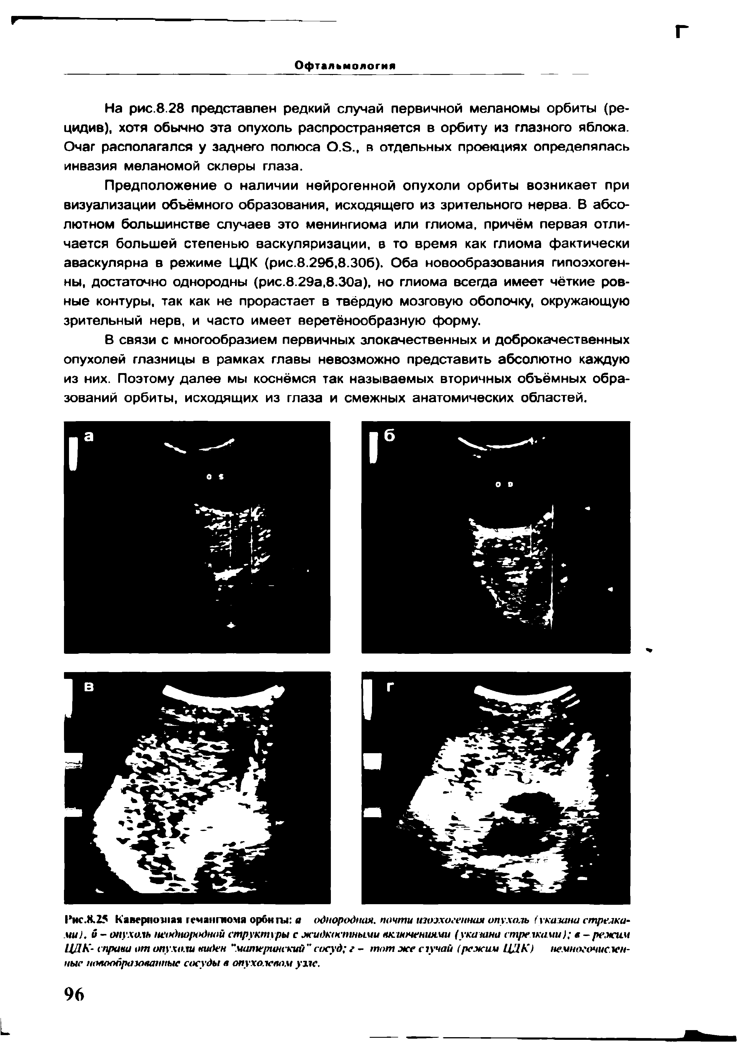 Рис.Х.25 Кавернозная гемангиома орбиты а однородная. почти изоэхогенная опухоль (указана стрелками . и - опухоль неоднородной структуры с жидкостными включениями (указана стрелками) в—режим ЦДК- справа от опухоли виден материнский сосуд г - тот же сзучай (режим ЦДК немногочисленные новообразованные сосуды в опухолевом узле.