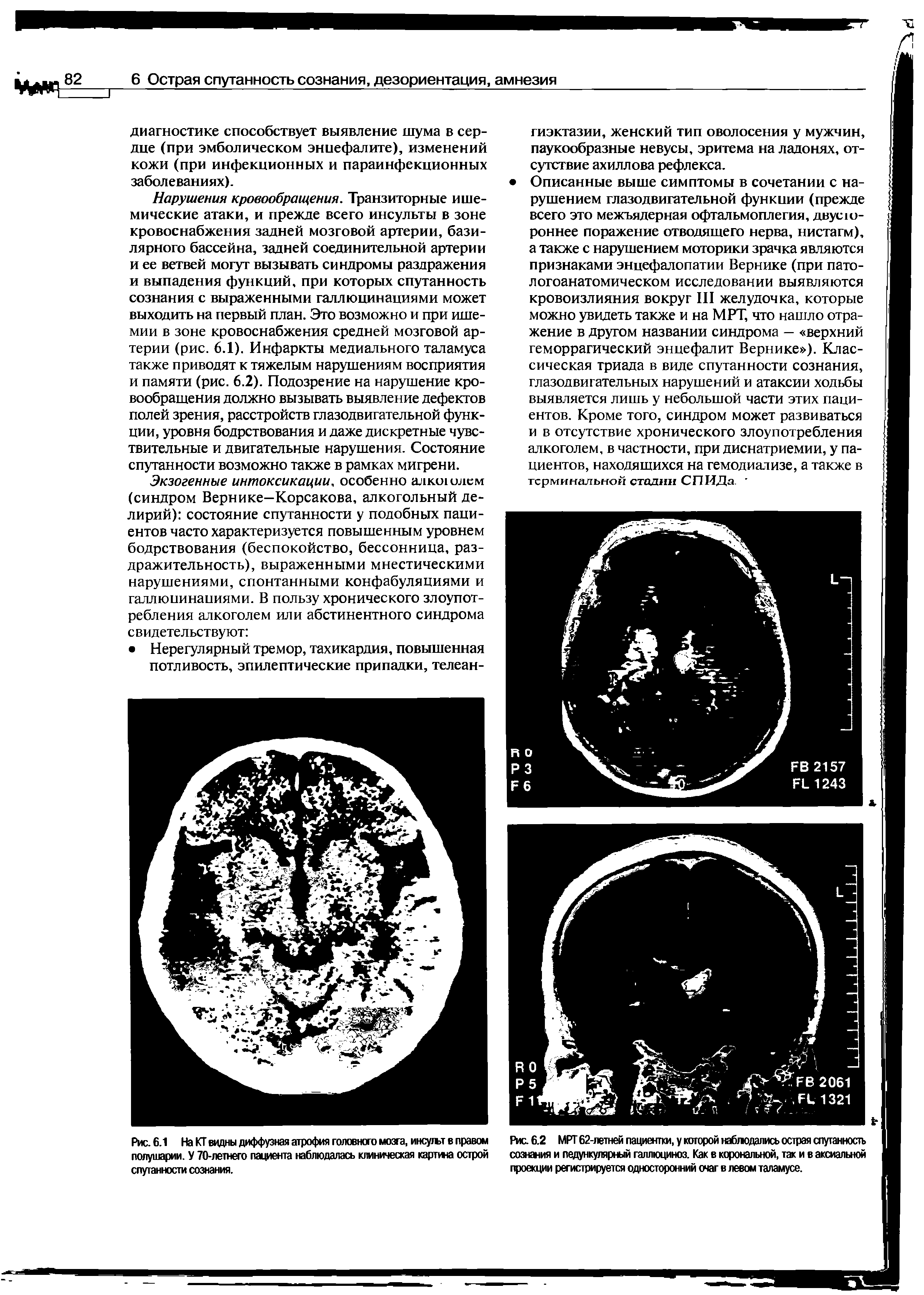 Рис. 6.1 На КГ видны диффузная атрофия головного мозга, инсульт в правом полушарии. У 70-летнего пациента наблюдалась клиническая картина острой спутанности сознания.