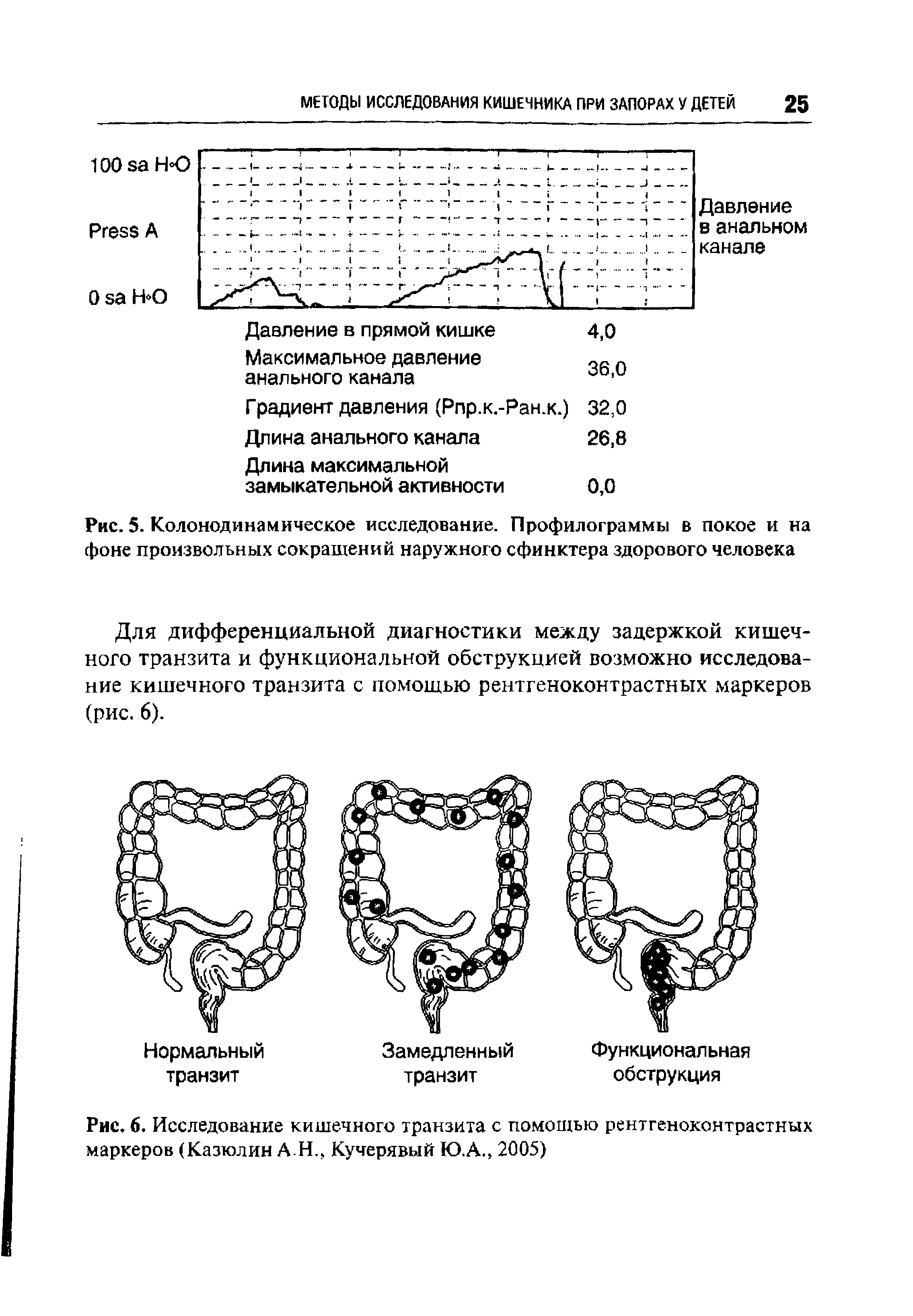 Рис. 5. Колонодинамическое исследование. Профилограммы в покое и на фоне произвольных сокращений наружного сфинктера здорового человека...