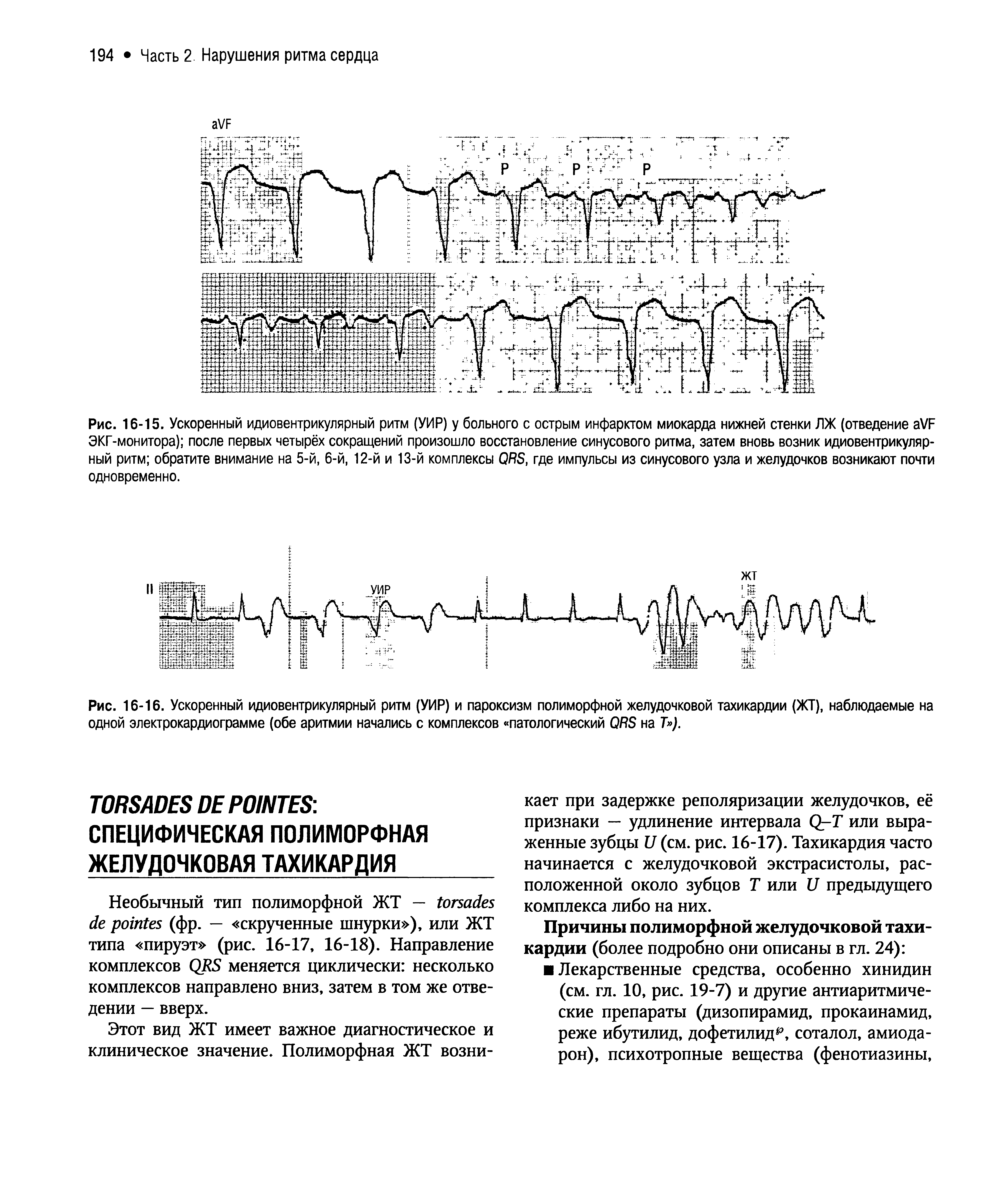 Рис. 16-16. Ускоренный идиовентрикулярный ритм (УИР) и пароксизм полиморфной желудочковой тахикардии (ЖТ), наблюдаемые на одной электрокардиограмме (обе аритмии начались с комплексов патологический ОЯБ на Т ).