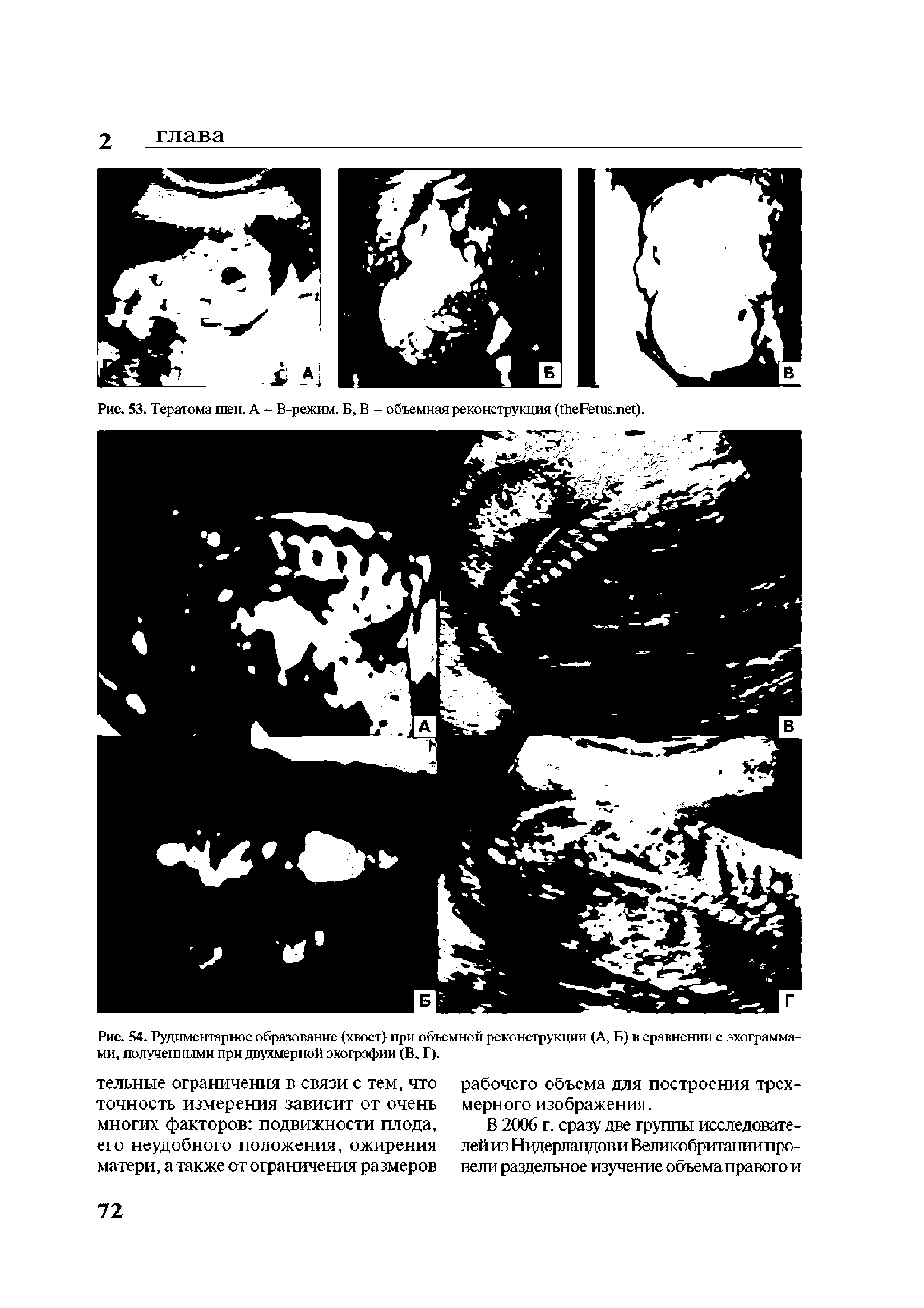 Рис. 54. Рудиментарное образование (хвост) при объемной реконструкции (А, Б) в сравнении с эхограммами, полученными при двухмерной эхографии (В, Г).