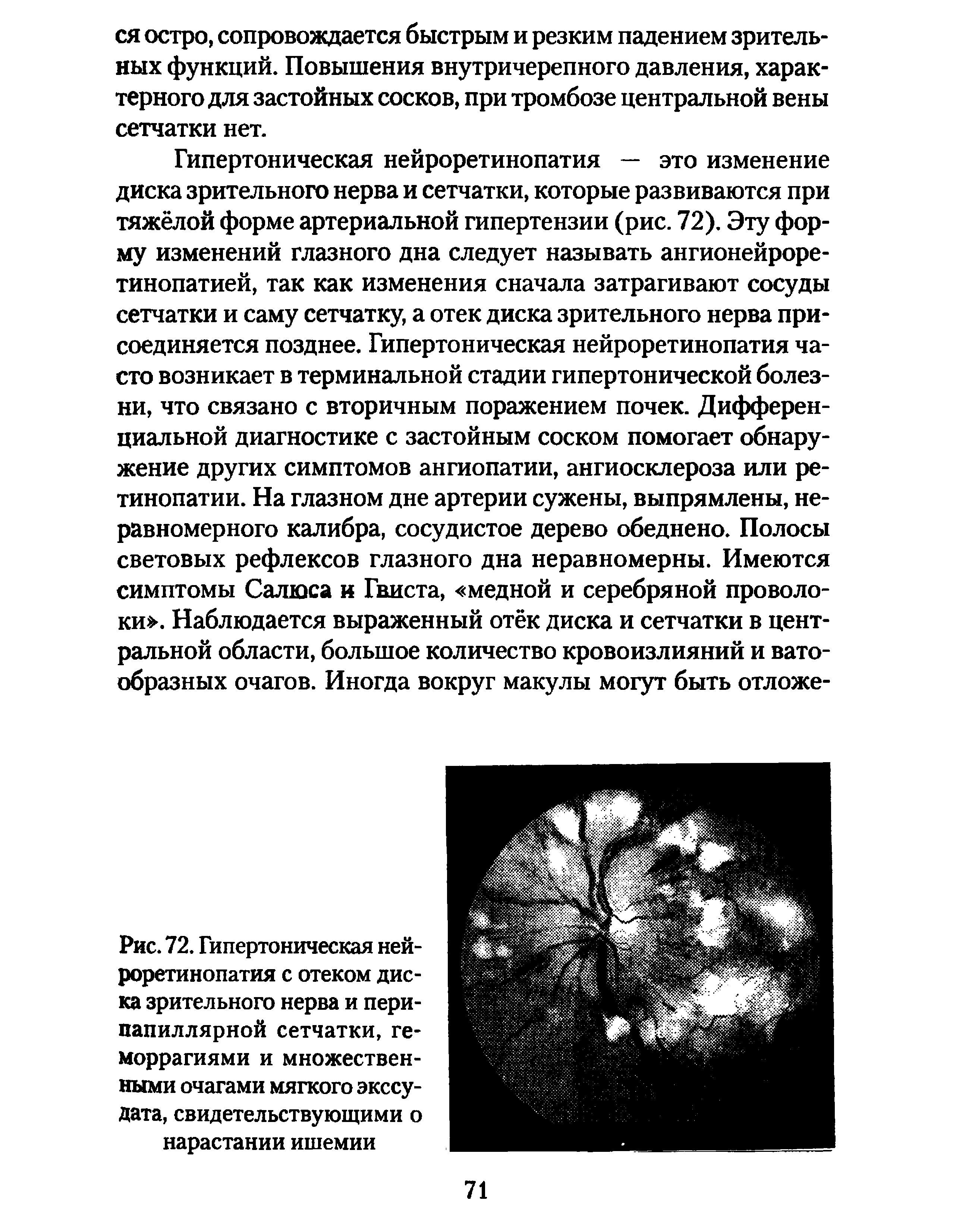 Рис. 72. Гипертоническая нейроретинопатия с отеком диска зрительного нерва и пери-папиллярной сетчатки, геморрагиями и множественными очагами мягкого экссудата, свидетельствующими о нарастании ишемии...