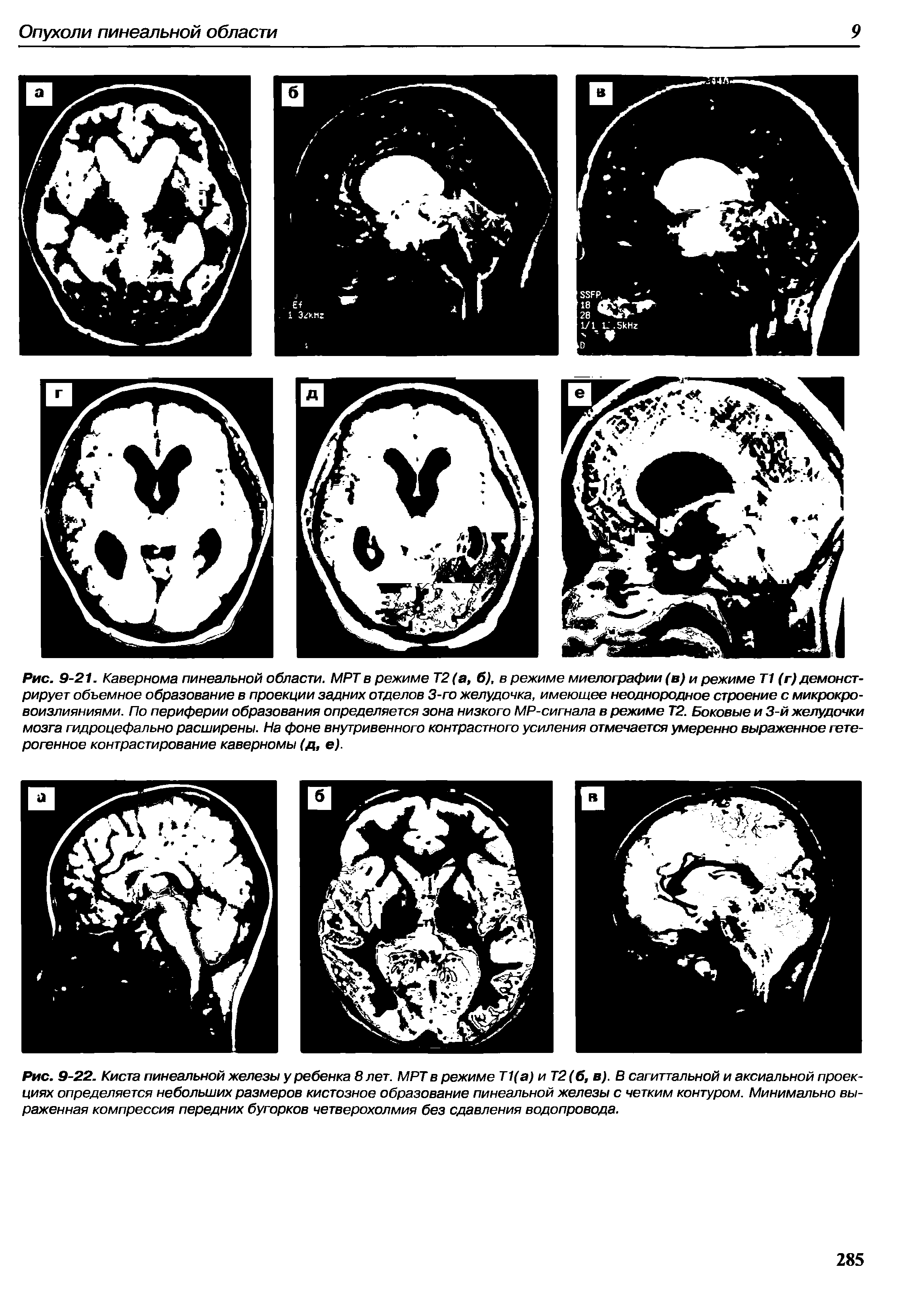 Рис. 9-22. Киста пинеальной железы у ребенка 8 лет. МРТ в режиме Т 1( ) и Т2 (б, в). В сагиттальной и аксиальной проекциях определяется небольших размеров кистозное образование пинеальной железы с четким контуром. Минимально выраженная компрессия передних бугорков четверохолмия без сдавления водопровода.