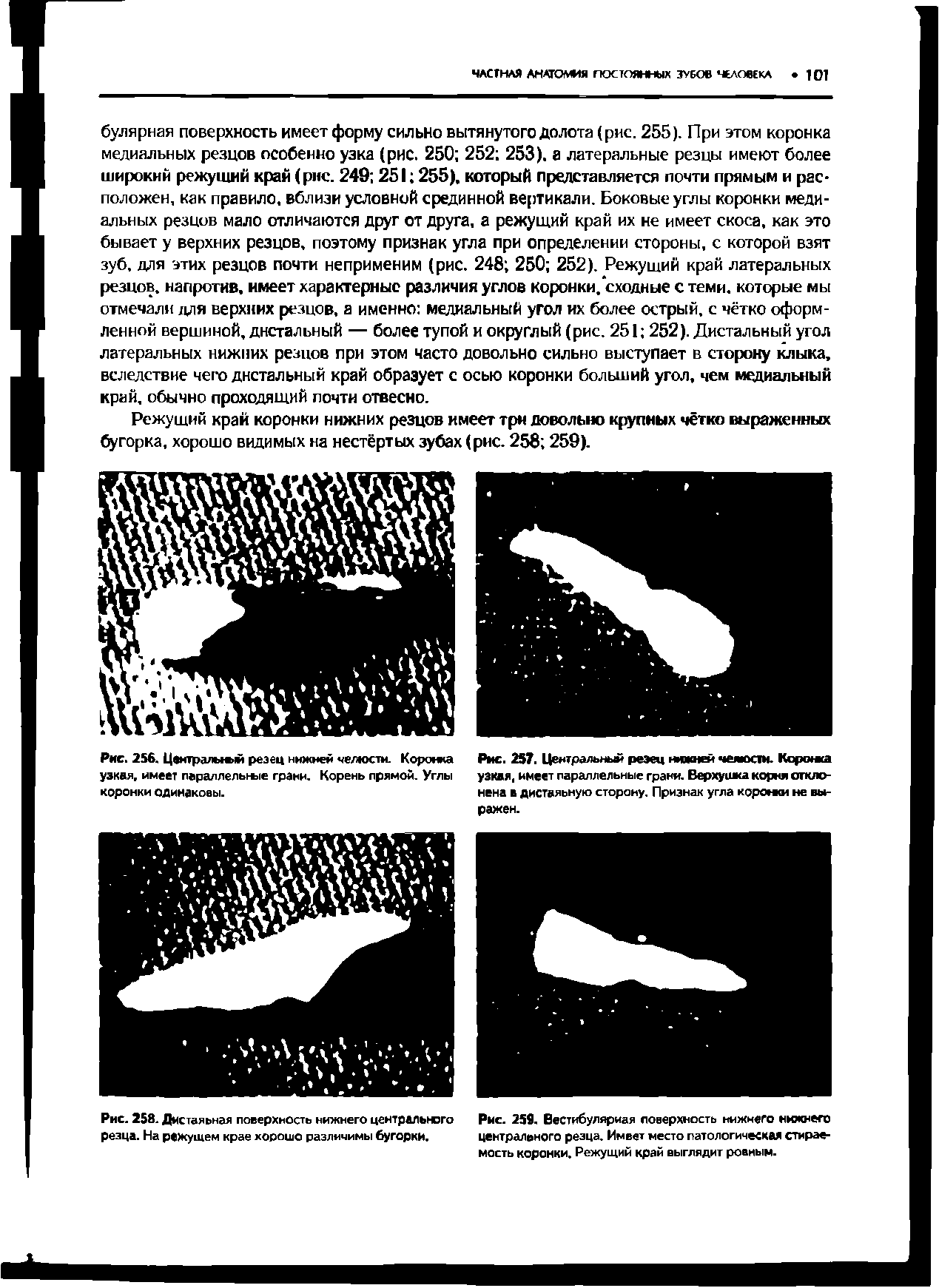 Рис. 256. Цемтральмяй резец нижней челюсти. Коронка узкая, имеет параллельные грани. Корень прямой. Углы коронки одинаковы.