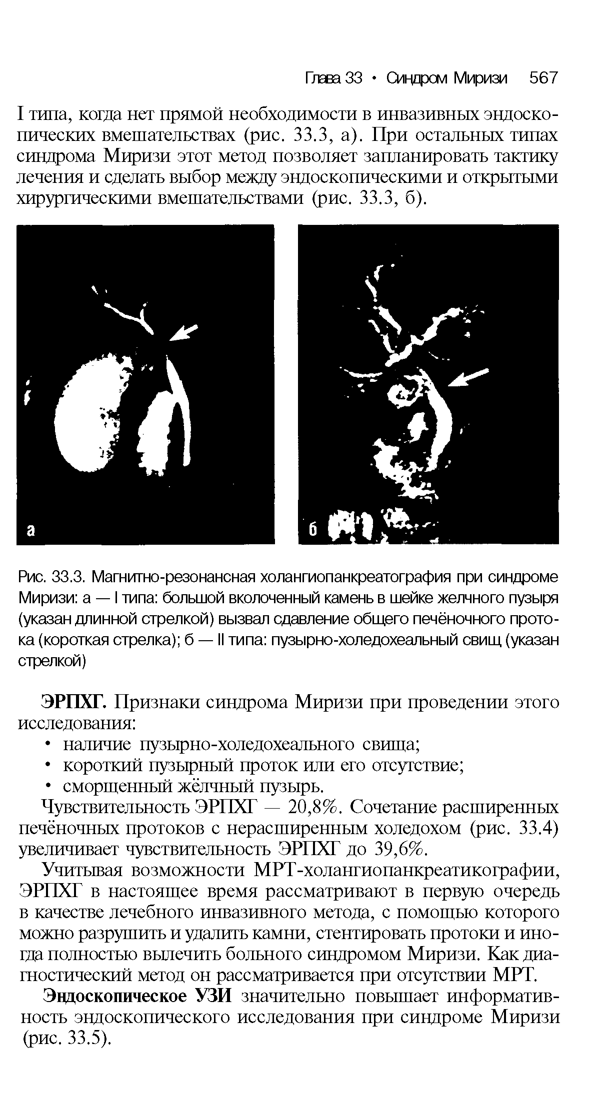 Рис. 33.3. Магнитно-резонансная холангиопанкреатография при синдроме Миризи а — I типа большой вколоченный камень в шейке желчного пузыря (указан длинной стрелкой) вызвал сдавление общего печёночного протока (короткая стрелка) б — II типа пузырно-холедохеальный свищ (указан стрелкой)...