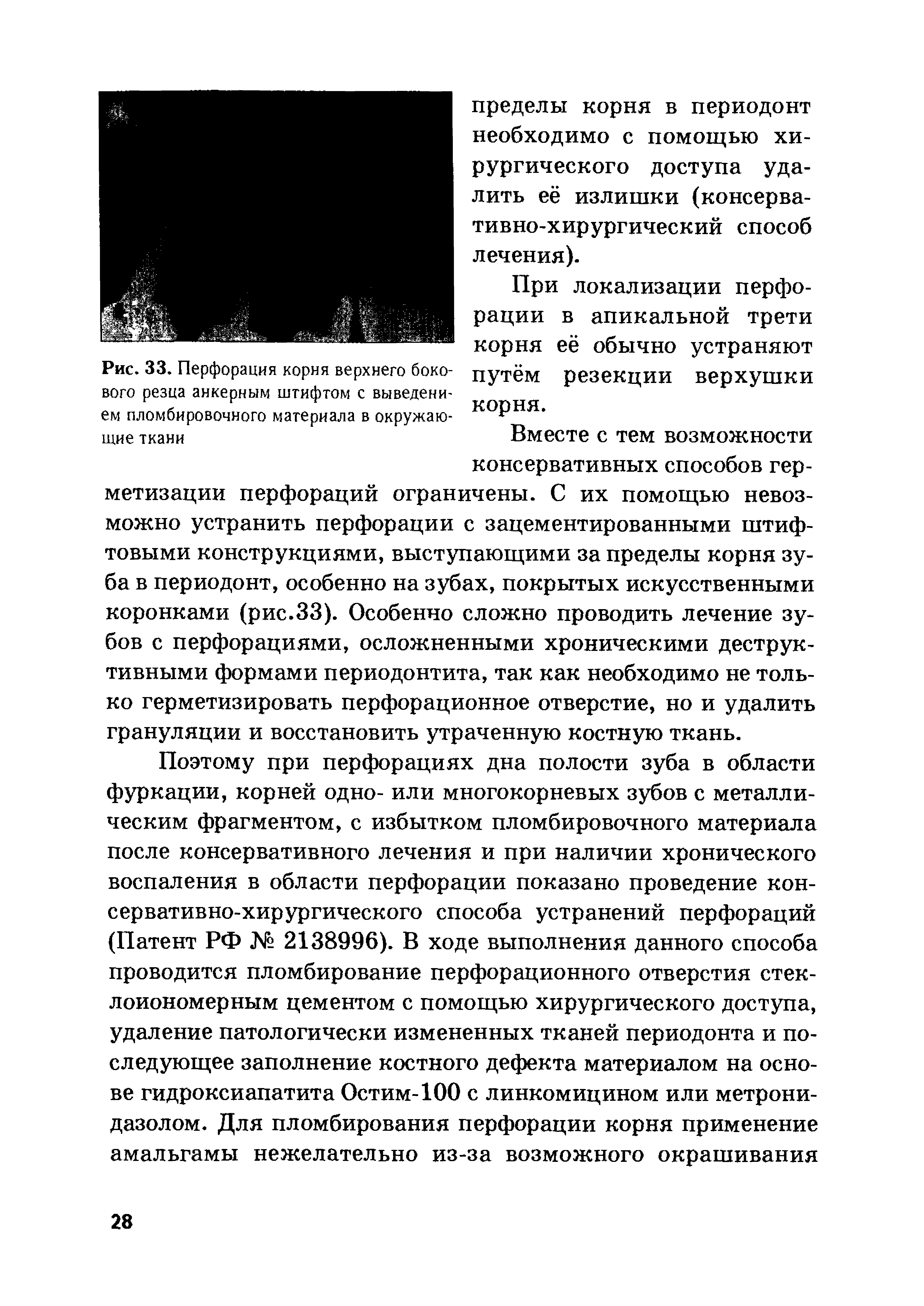 Рис. 33. Перфорация корня верхнего боко- путём вого резца анкерным штифтом с выведением пломбировочного материала в окружаю-щие ткани Вместе с тем возможности...