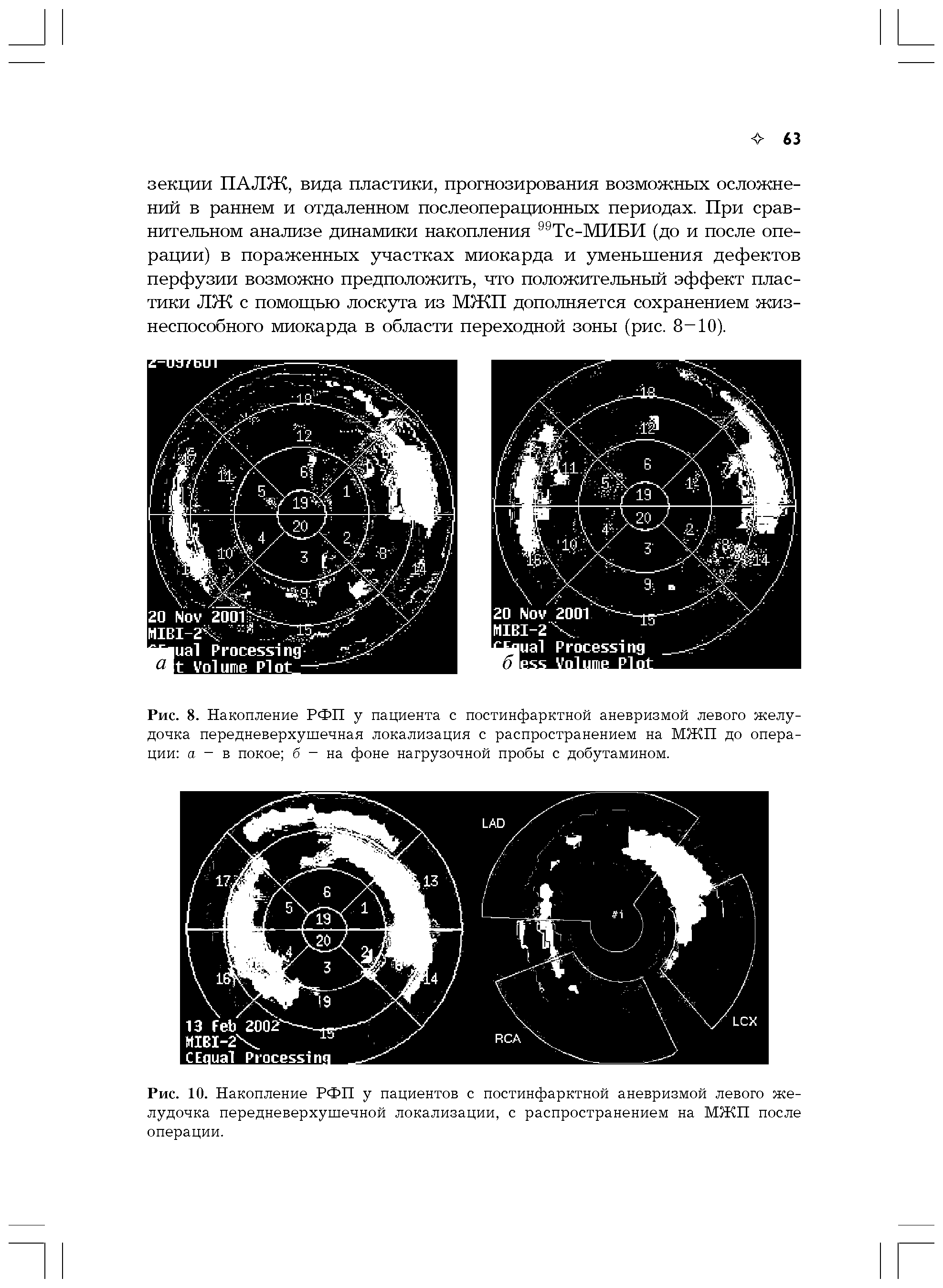 Рис. 8. Накопление РФП у пациента с постинфарктной аневризмой левого желудочка передневерхушечная локализация с распространением на МЖП до операции а - в покое б - на фоне нагрузочной пробы с добутамином.