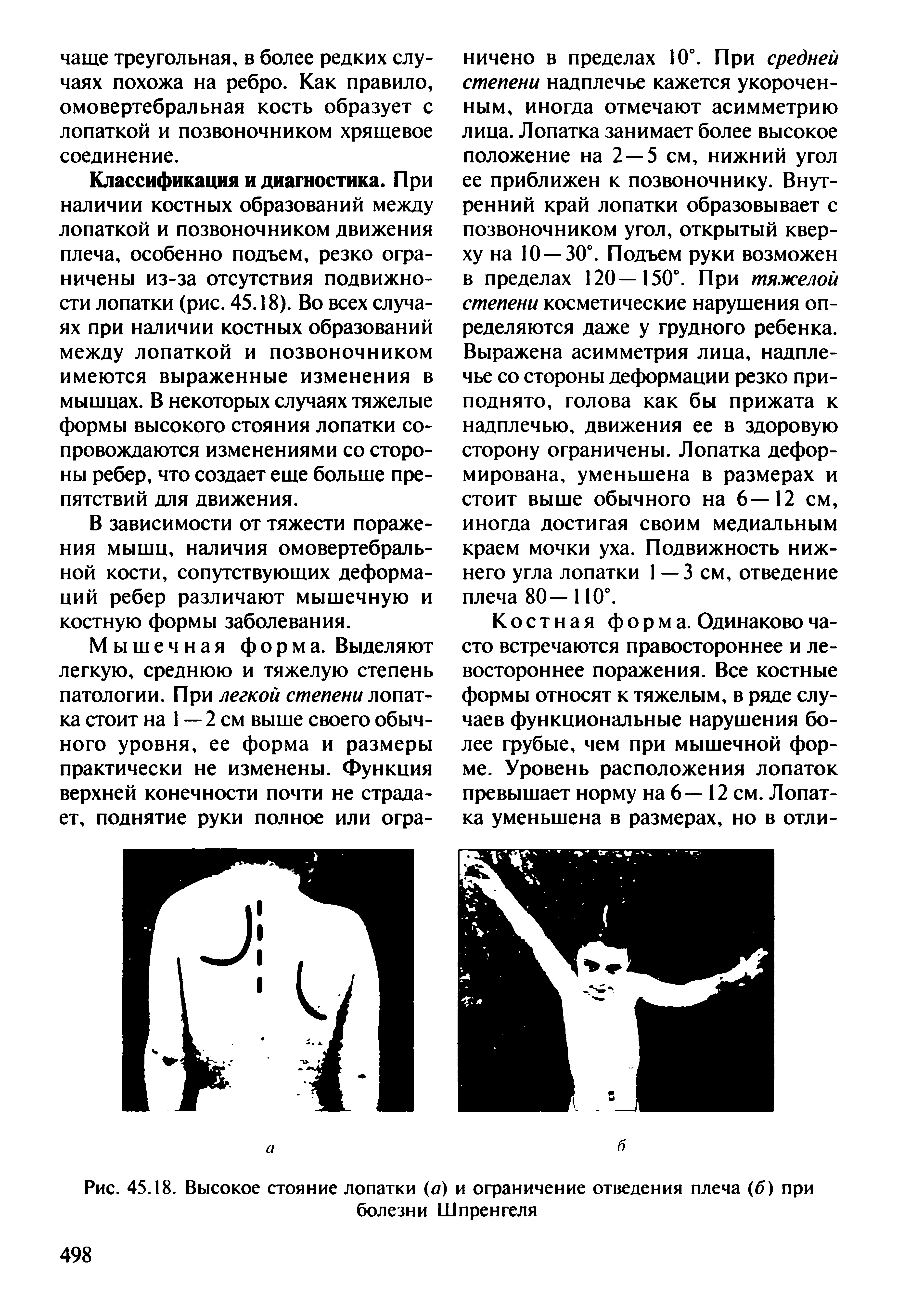 Рис. 45.18. Высокое стояние лопатки (а) и ограничение отведения плеча (б) при болезни Шпренгеля...
