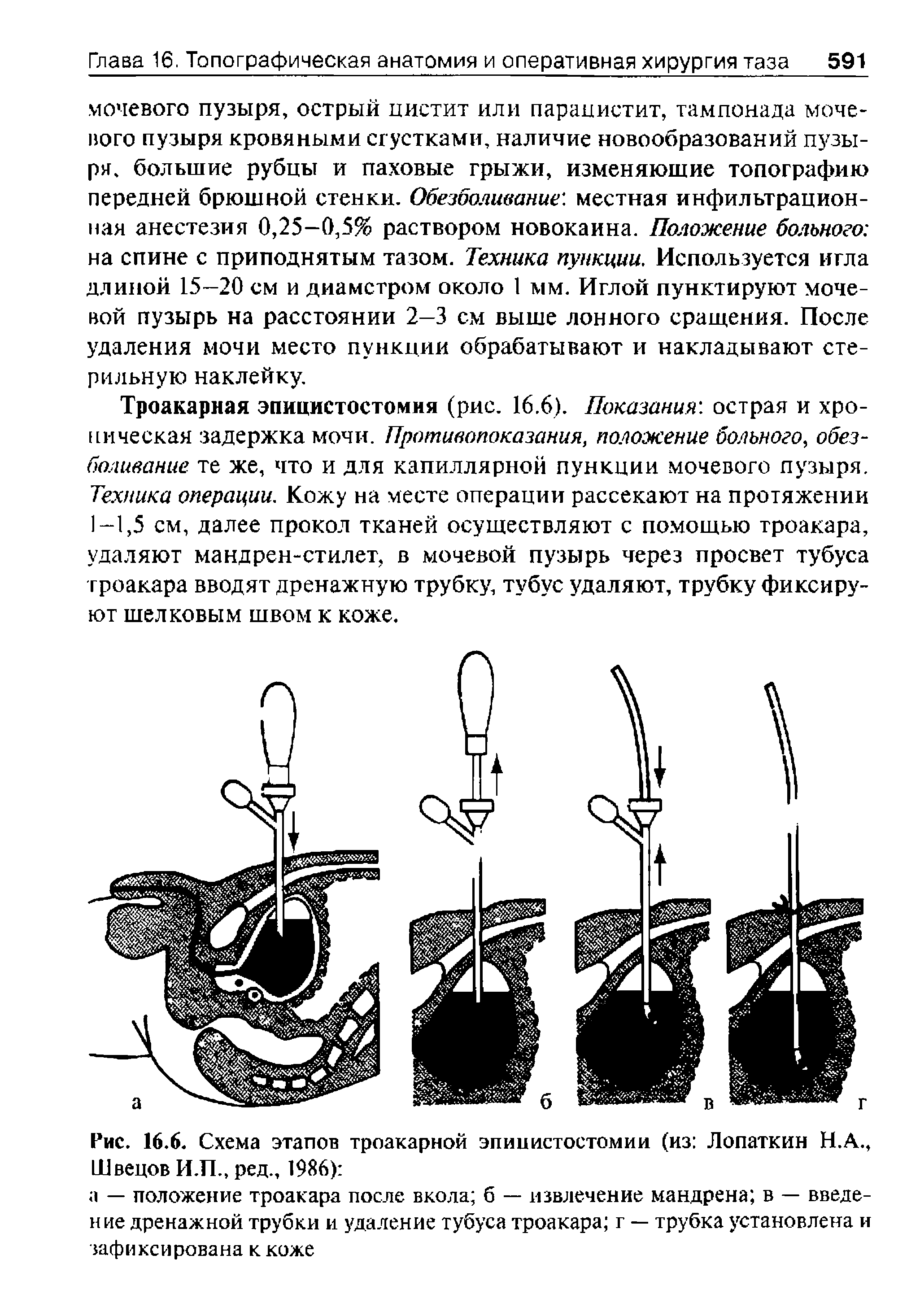 Рис. 16.6. Схема этапов троакарной эпицистостомии (из Лопаткин Н.А., Швецов И.П., ред., 1986) ...