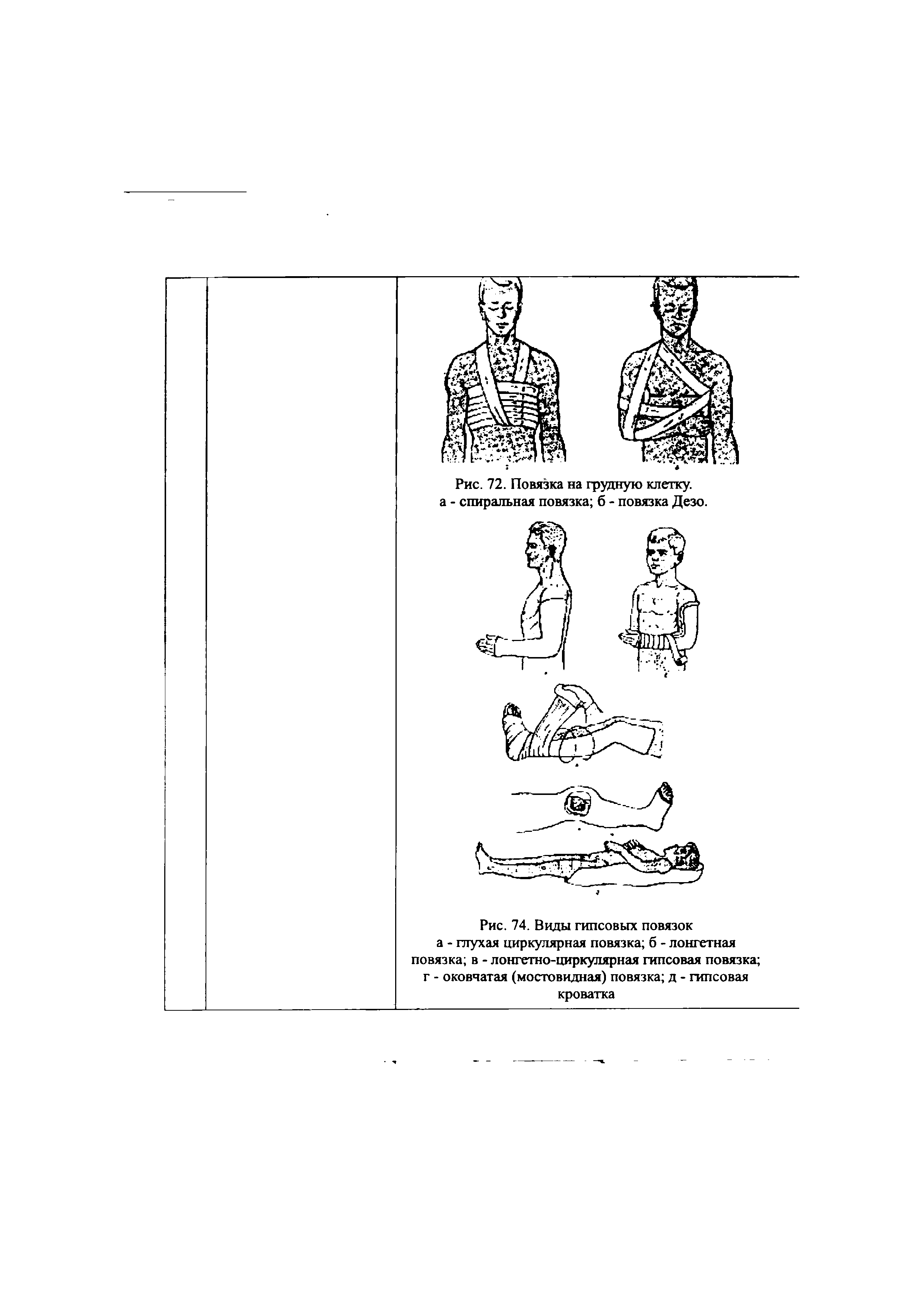 Рис. 74. Виды гипсовых повязок а - глухая циркулярная повязка б - лонгетная повязка в - лонгетно-циркулярная гипсовая повязка г - оковчатая (мостовидная) повязка д - гипсовая кроватка...