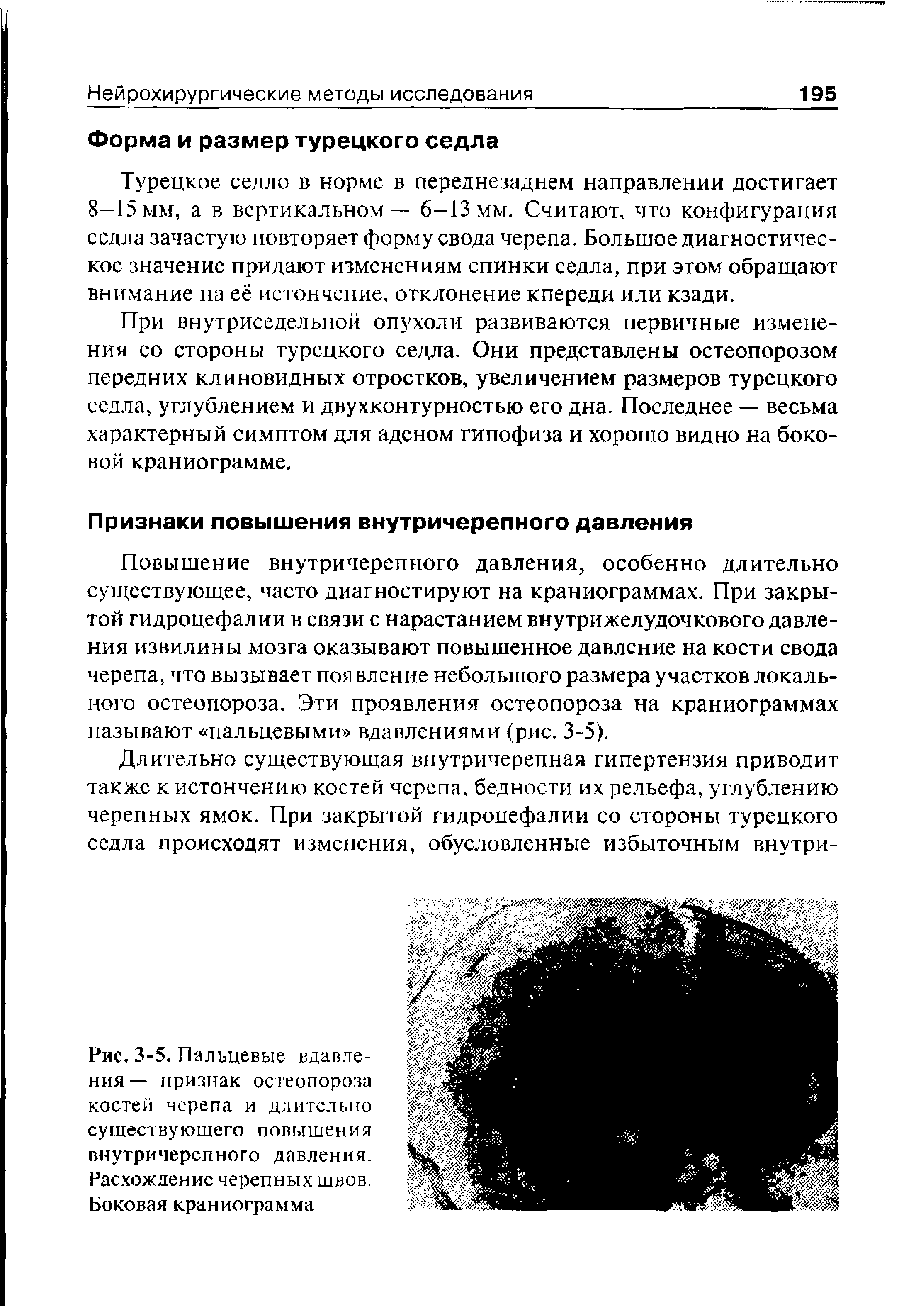 Рис. 3-5. П алъцевые вдавле-ния — признак остеопороза костей черепа и длительно существующего повышения внутричерепного давления. Расхождение черепных швов. Боковая краниограмма...