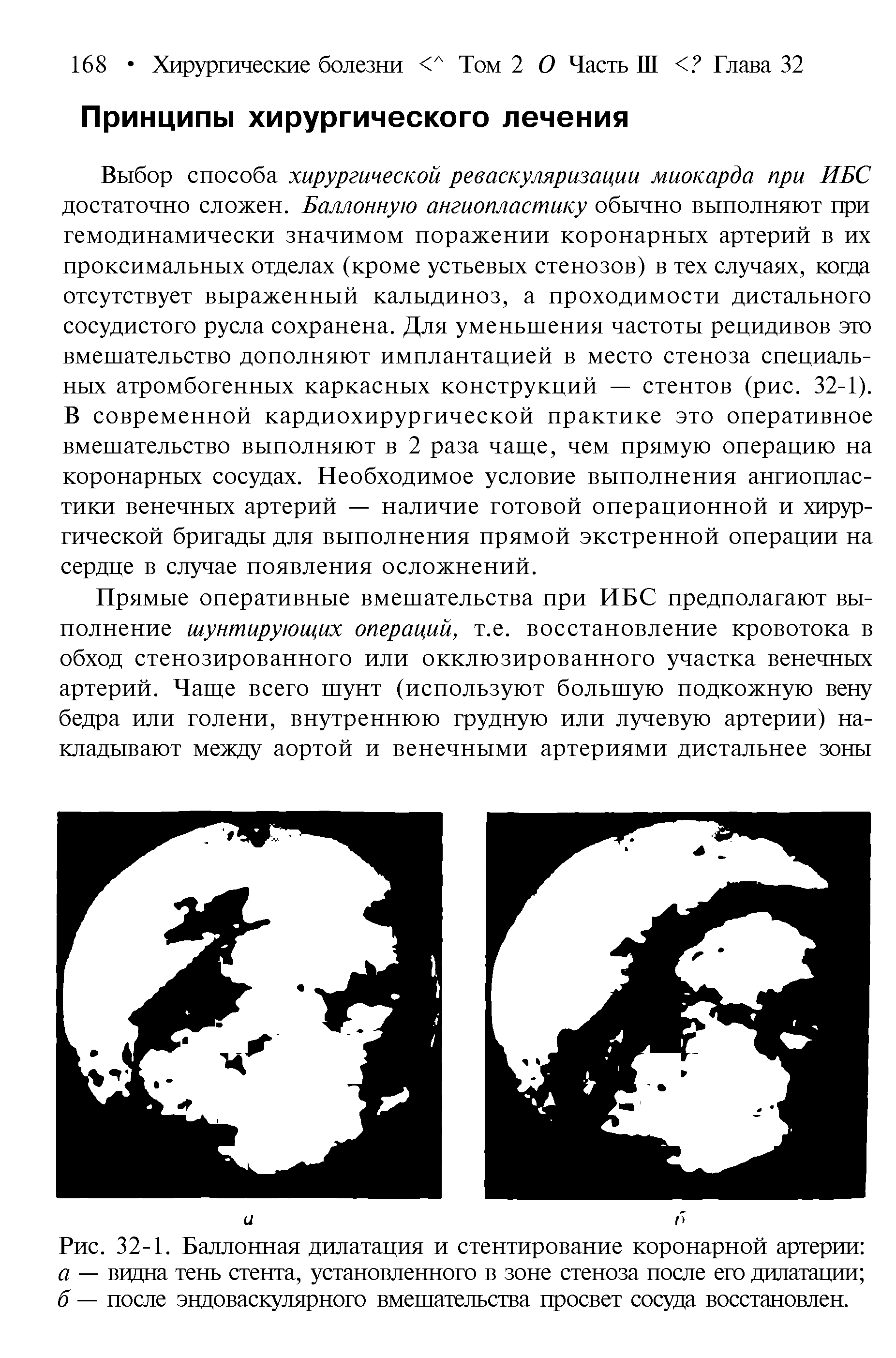 Рис. 32-1. Баллонная дилатация и стентирование коронарной артерии а — видна тень стента, установленного в зоне стеноза после его дилатации б — после эндоваскулярного вмешательства просвет сосуда восстановлен.