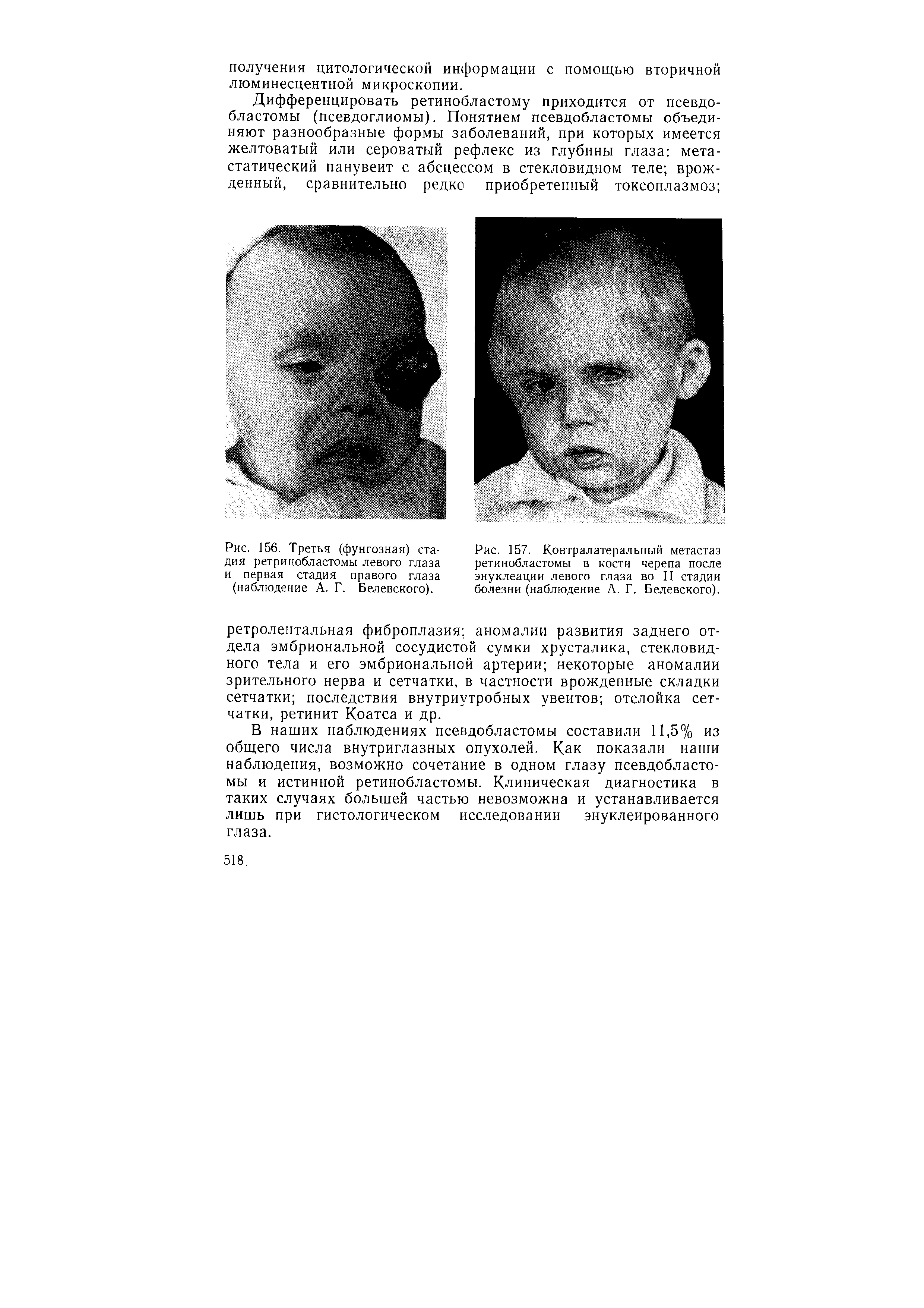 Рис. 157. Контралатеральный метастаз ретинобластомы в кости черепа после энуклеации левого глаза во II стадии болезни (наблюдение А. Г. Белевского).