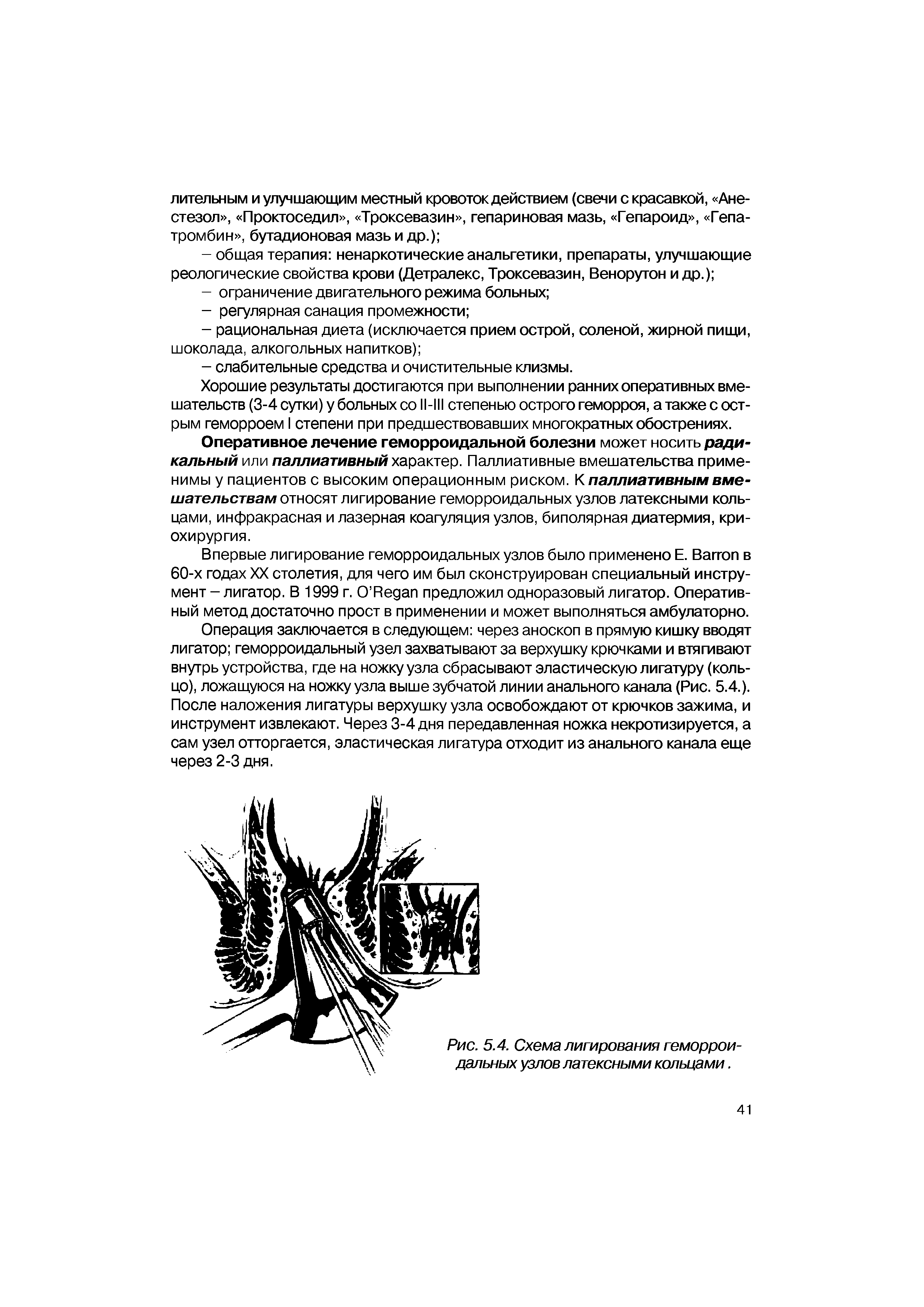 Рис. 5.4. Схема лигирования геморроидальных узлов латексными кольцами.