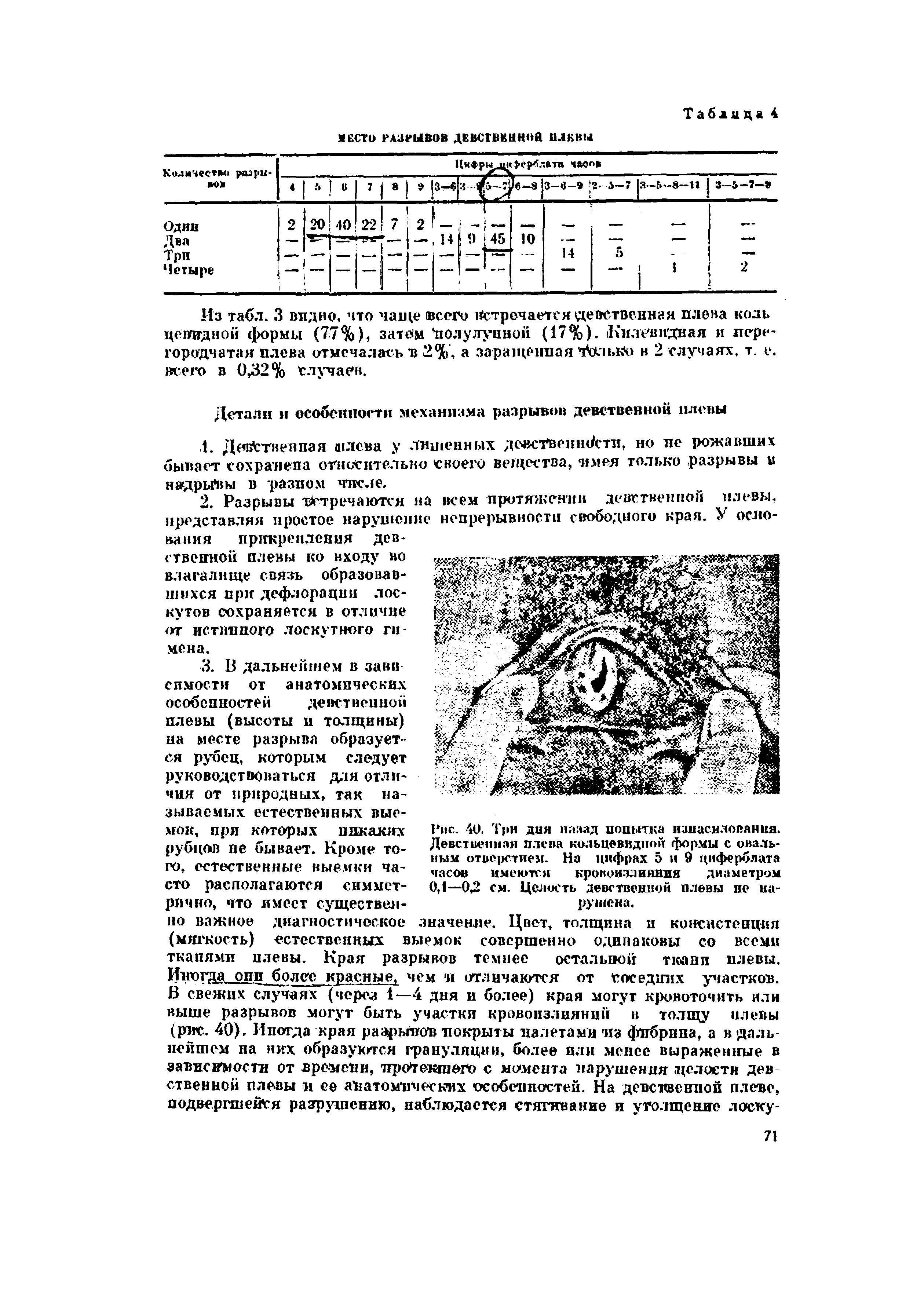 Рис. 40. Три дня назад ионы-пи изнасилования. Девственная плева кольцевидной формы с овальным отверстием. На цифрах 5 и 9 циферблата часов имеются кровоизлияния диаметром 0,1—ОД см. Целость девственной плевы не нарушена.