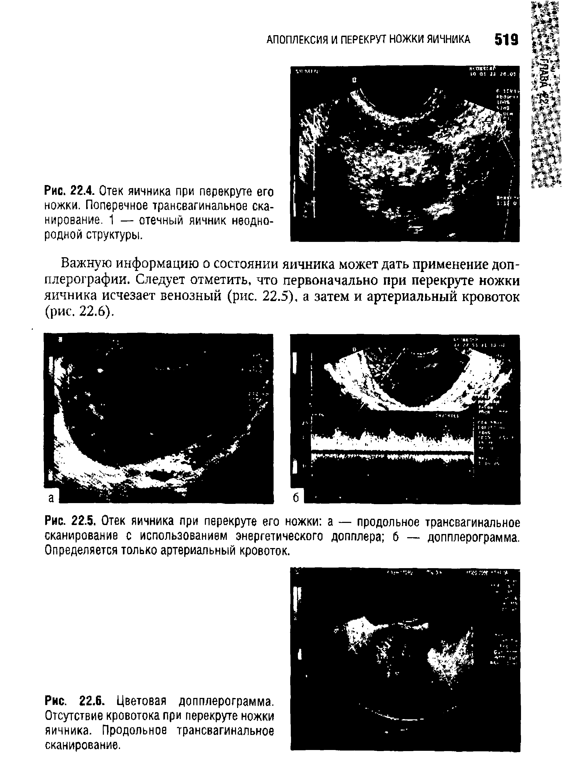 Рис. 22.5. Отек яичника при перекруте его ножки а — продольное трансвагинальное сканирование с использованием энергетического допплера б — допплерограмма. Определяется только артериальный кровоток.