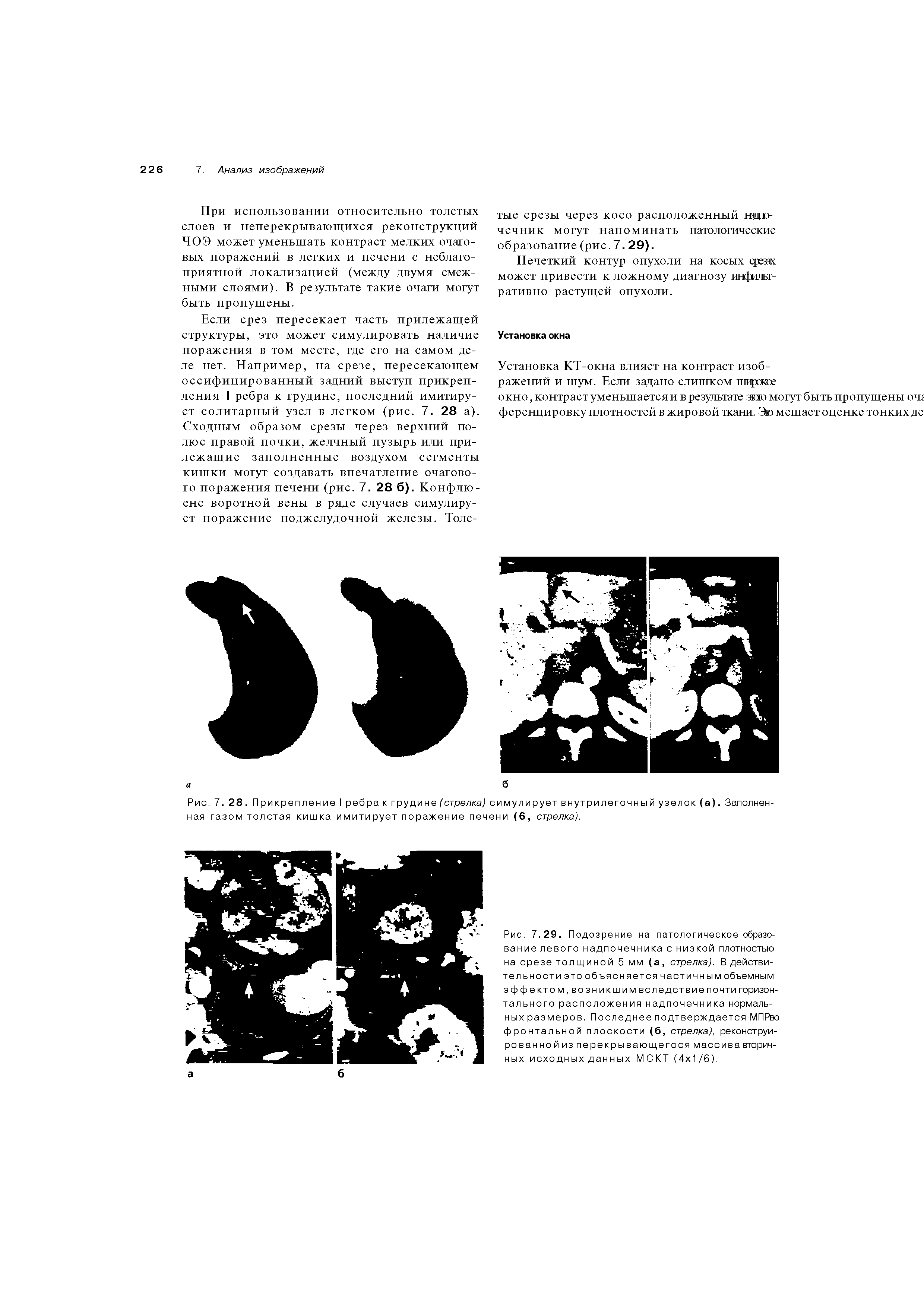 Рис. 7. 28. Прикрепление I ребрак грудине (стрелка) симулирует внутрилегочный узелок (а). Заполненная газом толстая кишка имитирует поражение печени (6, стрелка).