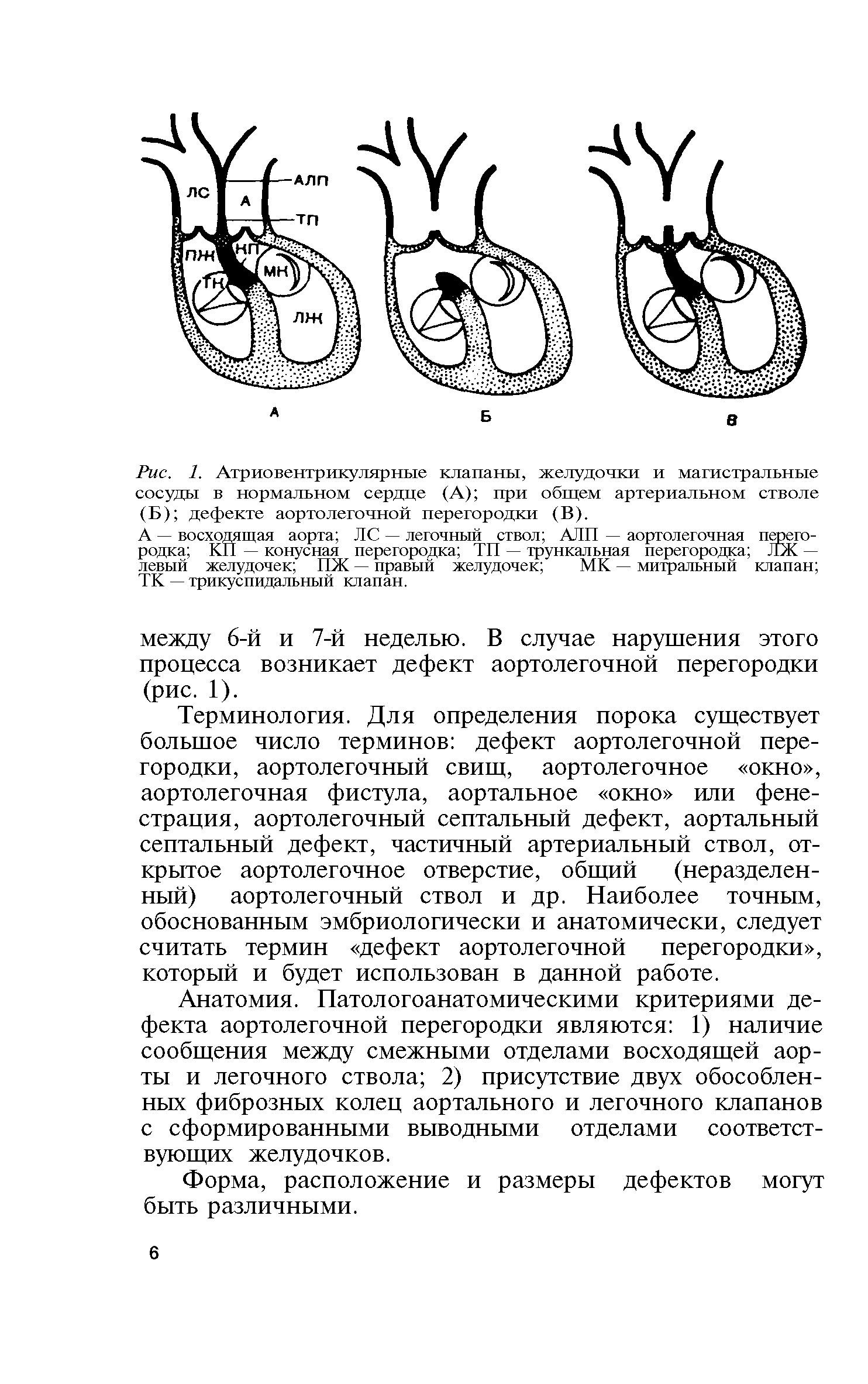 Рис. 1. Атриовентрикулярные клапаны, желудочки и магистральные сосуды в нормальном сердце (А) при общем артериальном стволе (Б) дефекте аортолегочной перегородки (В).