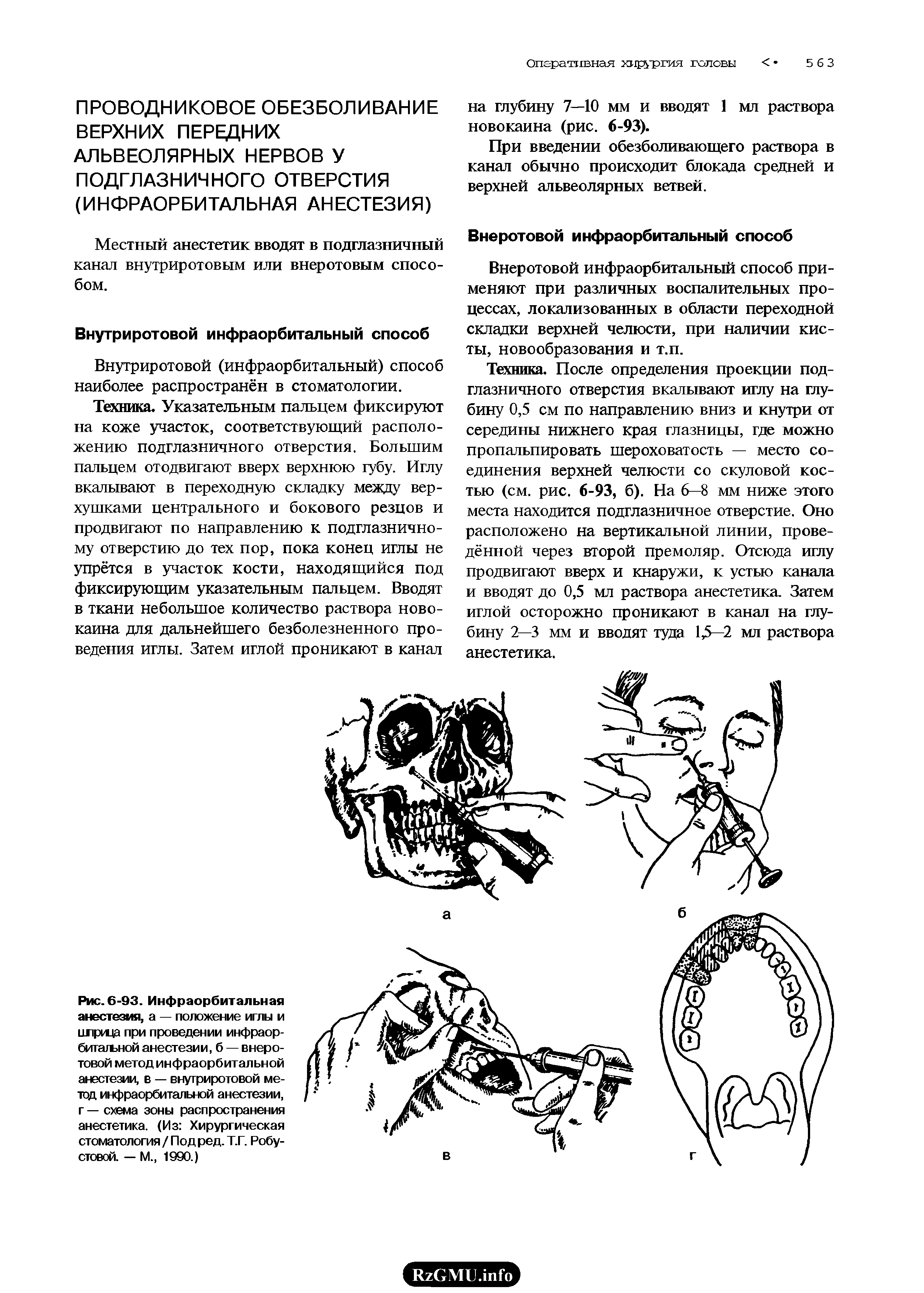 Рис. 6-93. Инфраорбитальная анестезия, а — положение иглы и шприца при проведении инфраорбитальной анестезии, б — внеротовой метод инфраорбитальной анестезии, в — внутриротовой метод инфраорбитальной анестезии, г — схема зоны распространения анестетика. (Из Хирургическая стоматология / Под ред. Т.Г. Робу-стовой. — М., 1990.)...