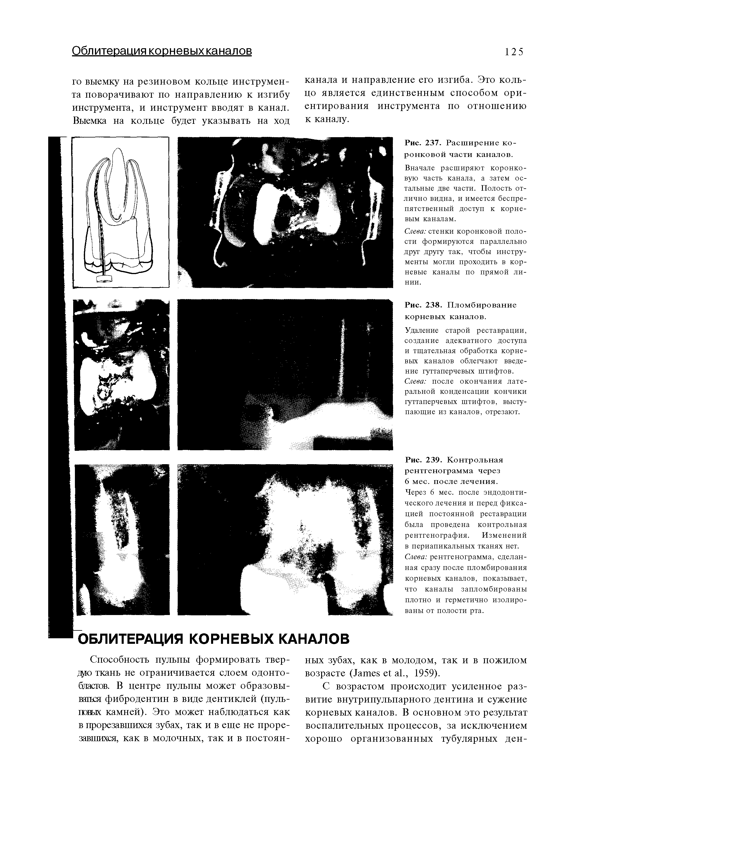 Рис. 237. Расширение коронковой части каналов. Вначале расширяют коронковую часть канала, а затем остальные две части. Полость отлично видна, и имеется беспрепятственный доступ к корневым каналам.