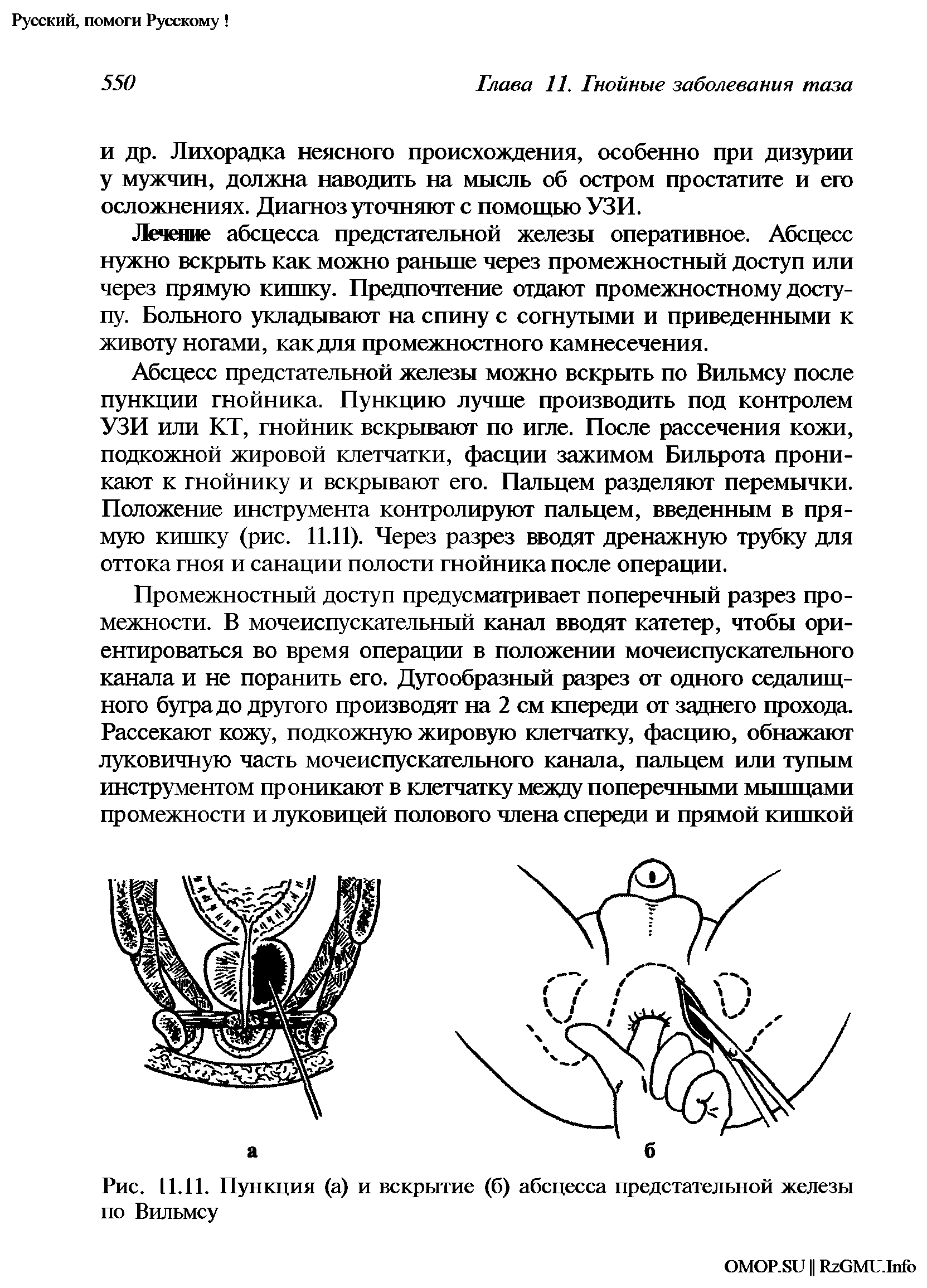 Рис. 11.11. Пункция (а) и вскрытие (б) абсцесса предстательной железы по Вильмсу...