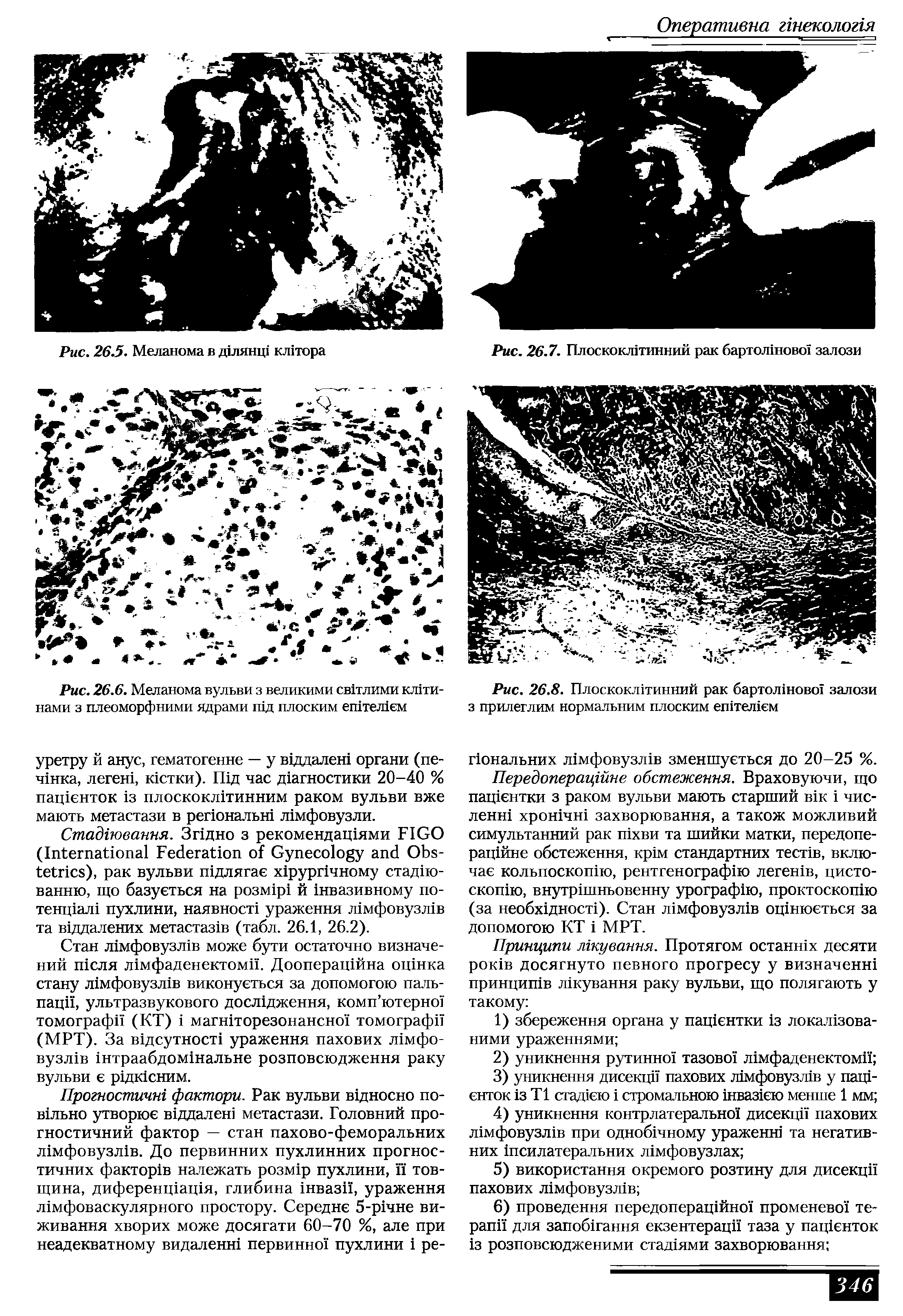 Рис. 26.6. Меланома вульви з великими свгглими кшти-нами з плеоморфними ядрами шд плоским ештел1ем...