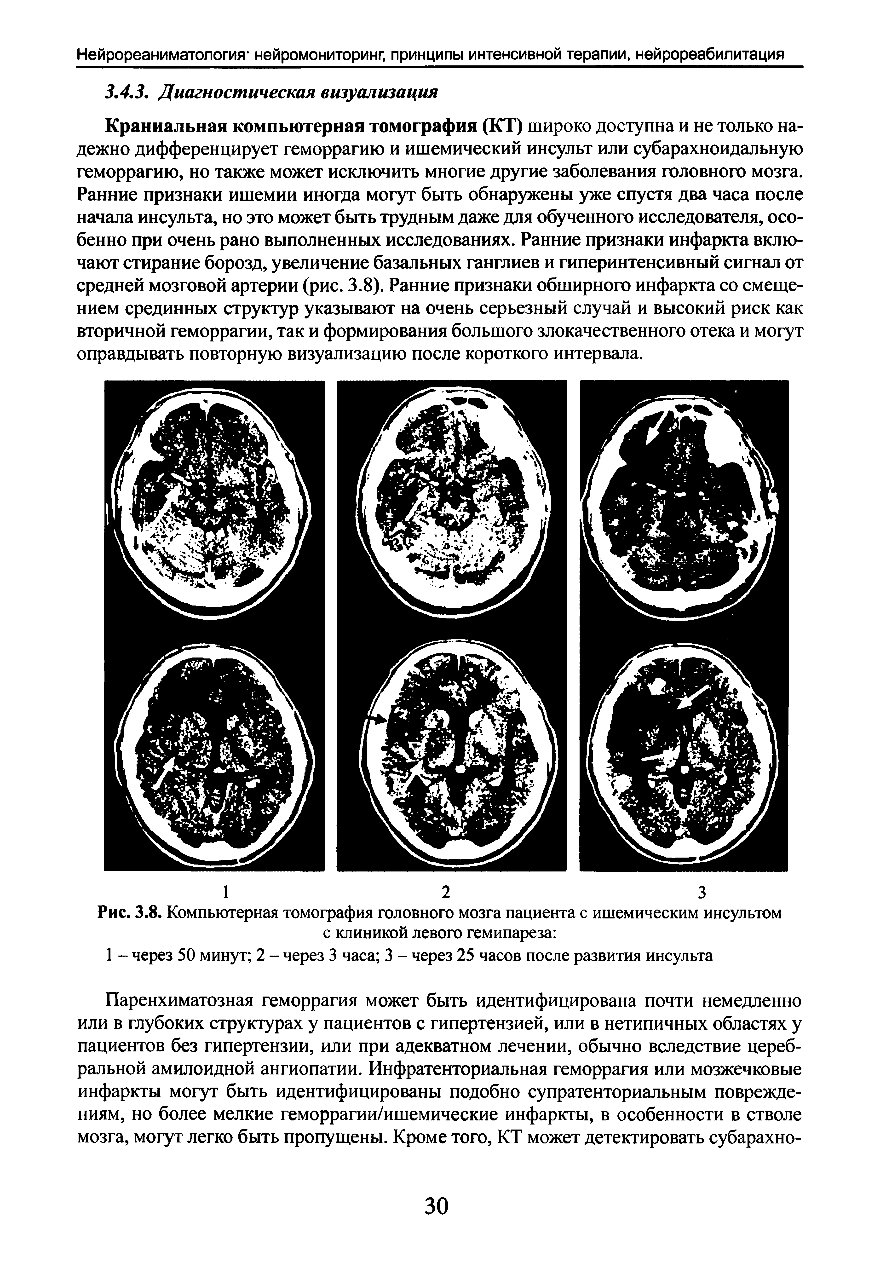Рис. 3.8. Компьютерная томография головного мозга пациента с ишемическим инсультом с клиникой левого гемипареза ...