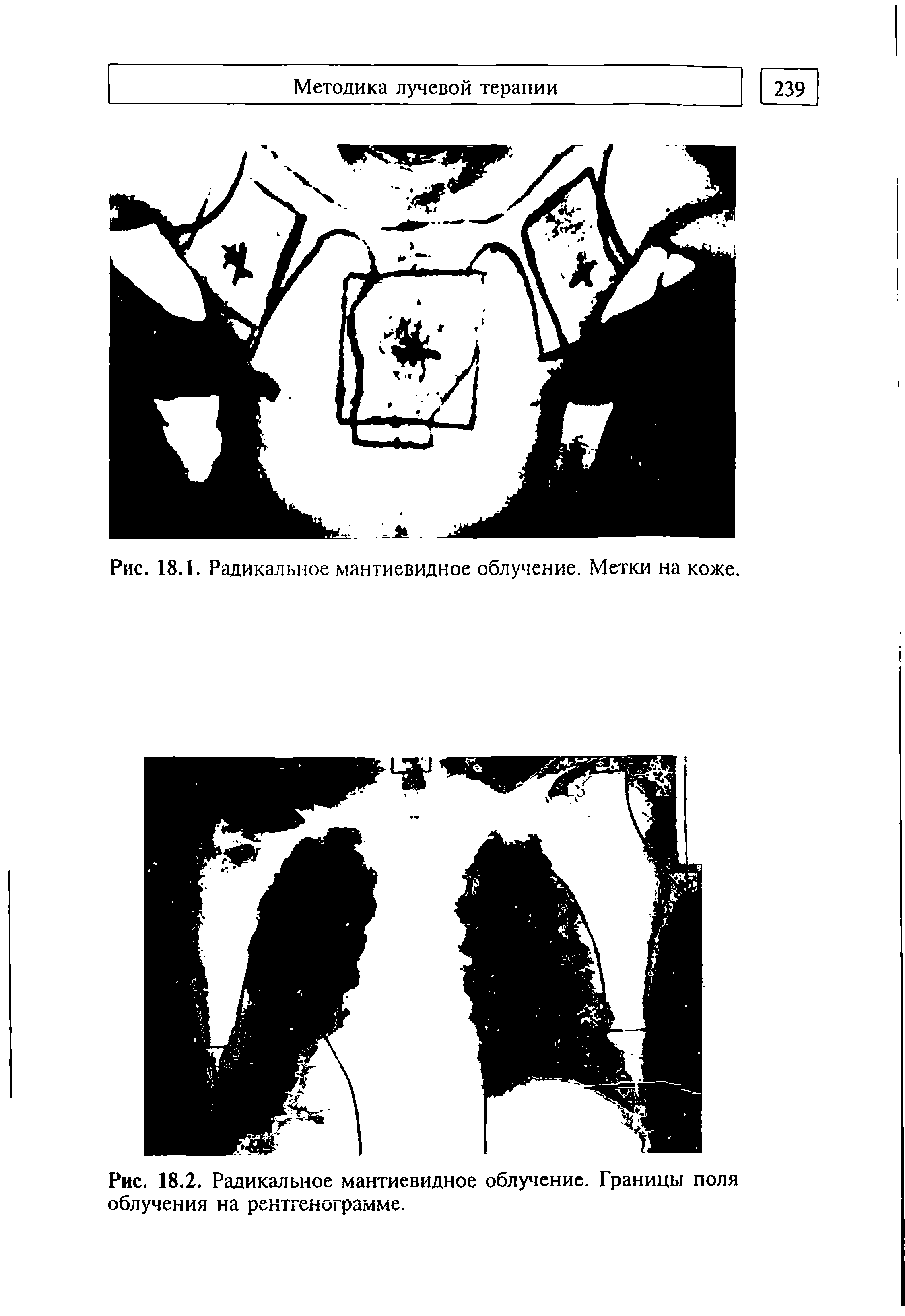 Рис. 18.2. Радикальное мантиевидное облучение. Границы поля облучения на рентгенограмме.