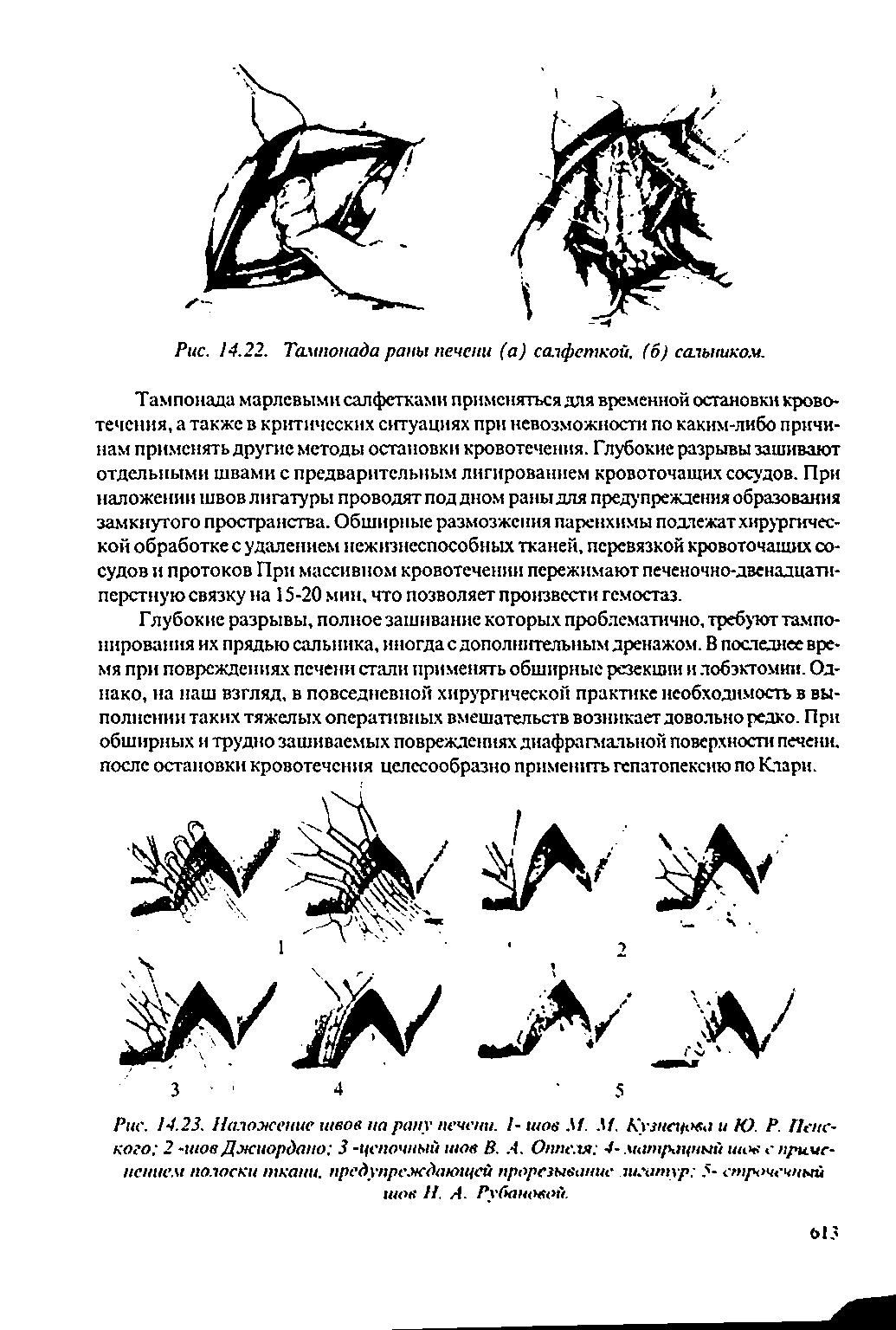 Рис. 14.23. Наложение швов на рану печени. /- шов М. М. Кузнецова и Ю. Р. Печского 2 -шов Джиордано 3 -цепочный шов В. А. Оппеля 4- матрацный шов е применением полоски ткани, предупреждающей прорезывание лилгтур 5- строчечный шов И. А. Рубановой.