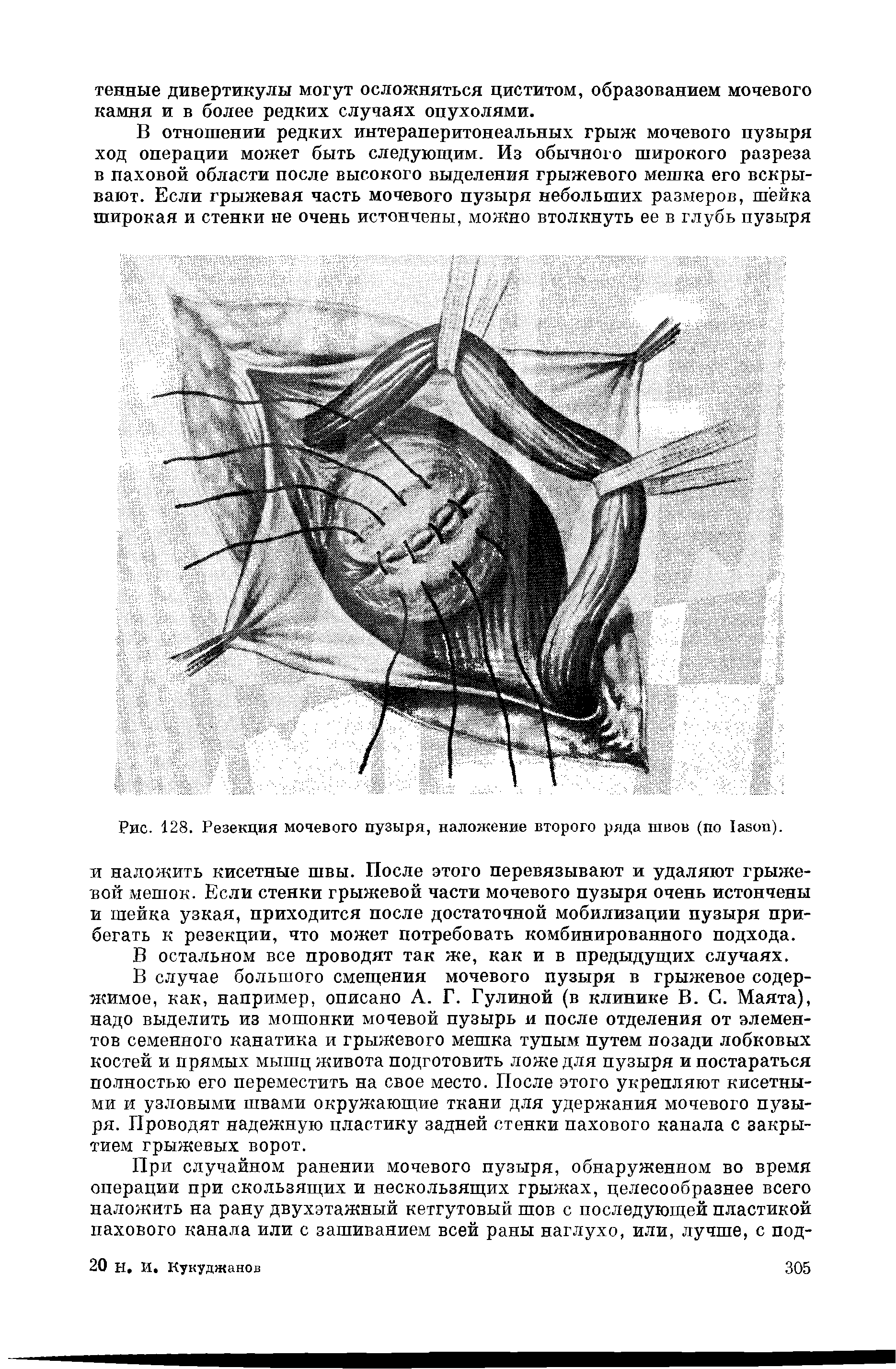 Рис. 128. Резекция мочевого пузыря, наложение второго ряда швов (по аяоп).