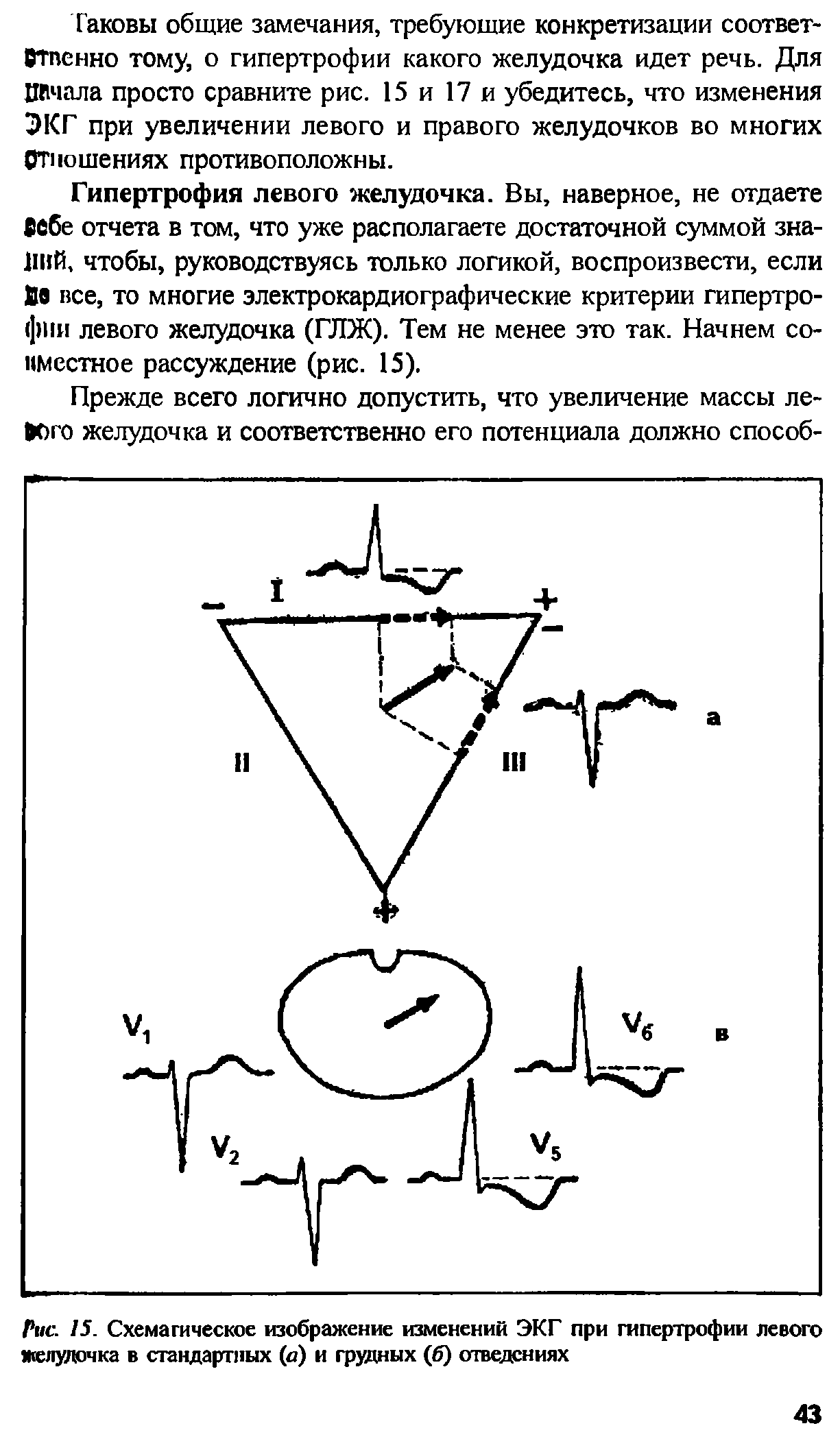 Рис. 15. Схемагическое изображение изменений ЭКГ при гипертрофии левого желудочка в стандартных (а) и грудных (б) отведениях...