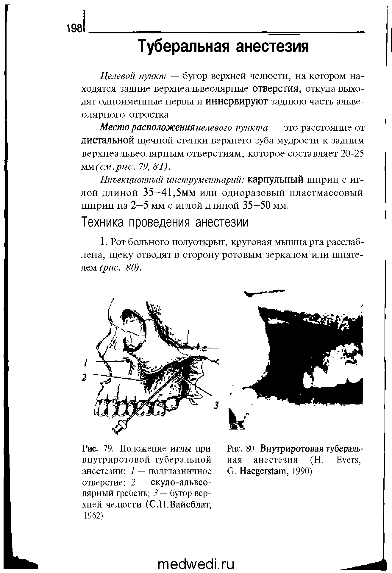 Рис. 79. Положение иглы при внутриротовой туберальной анестезии / — подглазничное отверстие 2 — скуло-альвеолярный гребень 3 — бугор верхней челюсти (С.Н.Вайсблат, 1962)...