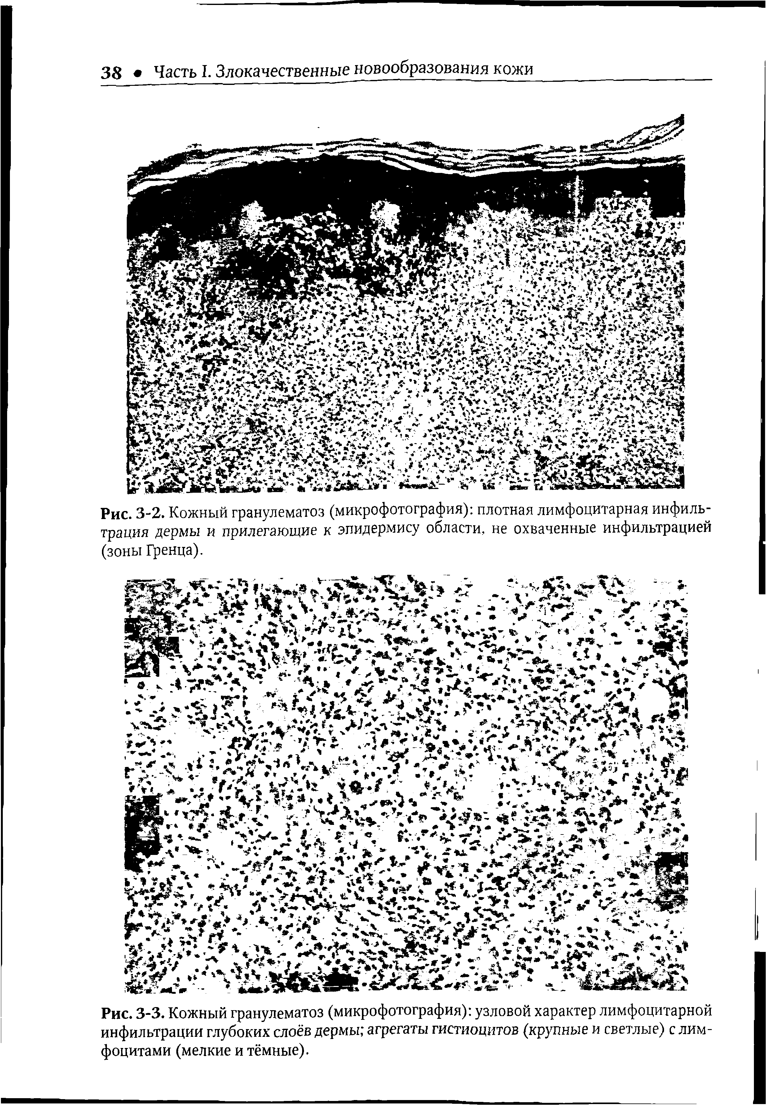 Рис. 3-3. Кожный гранулематоз (микрофотография) узловой характер лимфоцитарной инфильтрации глубоких слоёв дермы агрегаты гистиоцитов (крупные и светлые) с лимфоцитами (мелкие и тёмные).