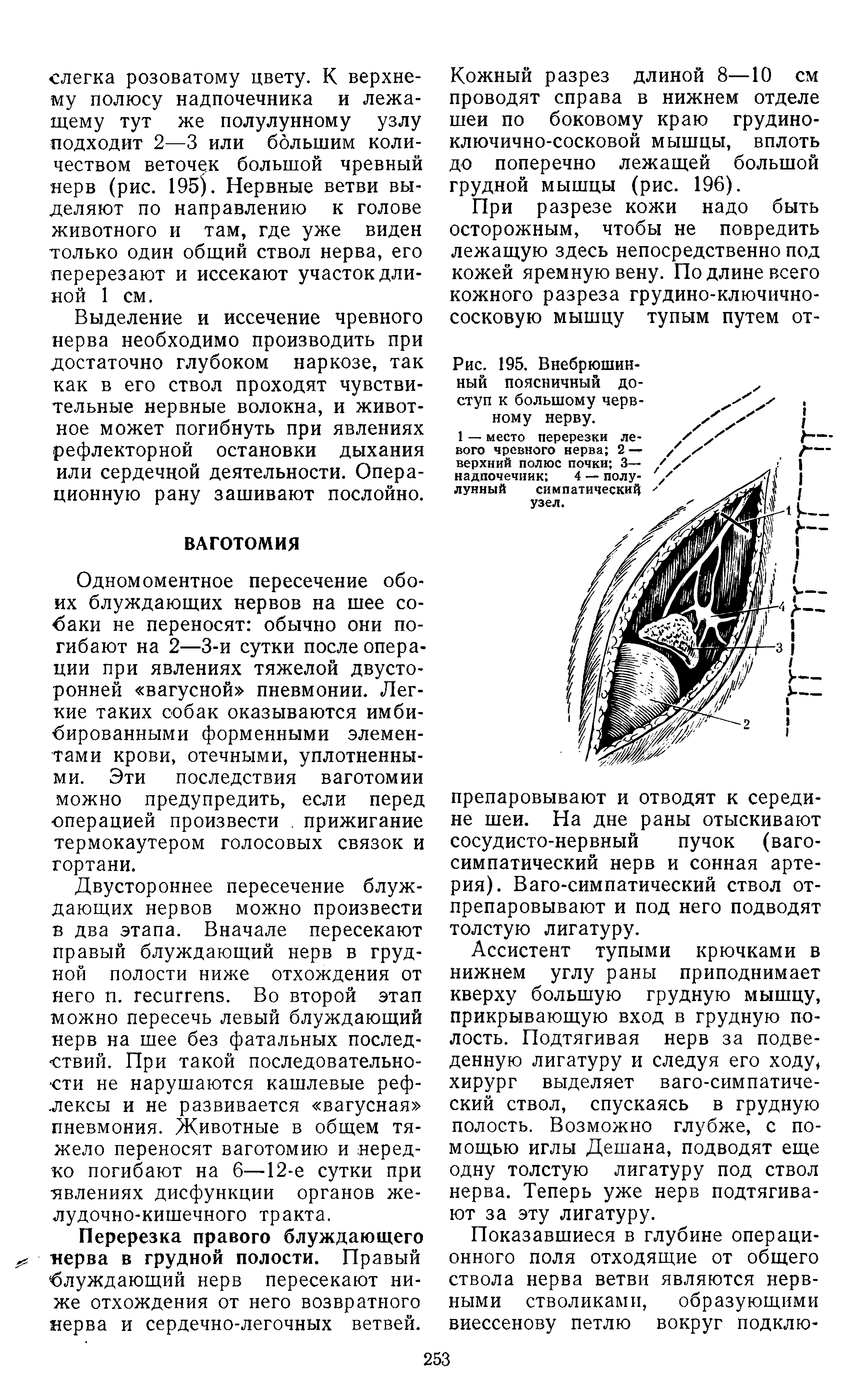 Рис. 195. Внебрюшин-ный поясничный доступ к большому нервному нерву.