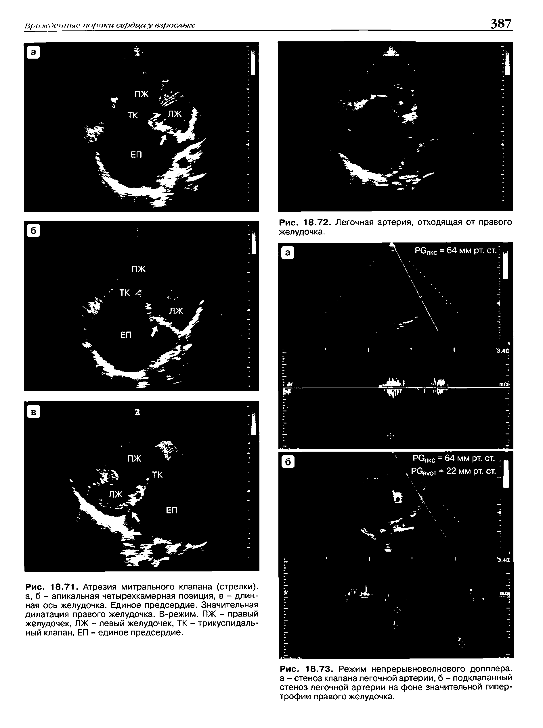 Рис. 18.73. Режим непрерывноволнового допплера, а - стеноз клапана легочной артерии, б - подклапанный стеноз легочной артерии на фоне значительной гипертрофии правого желудочка.