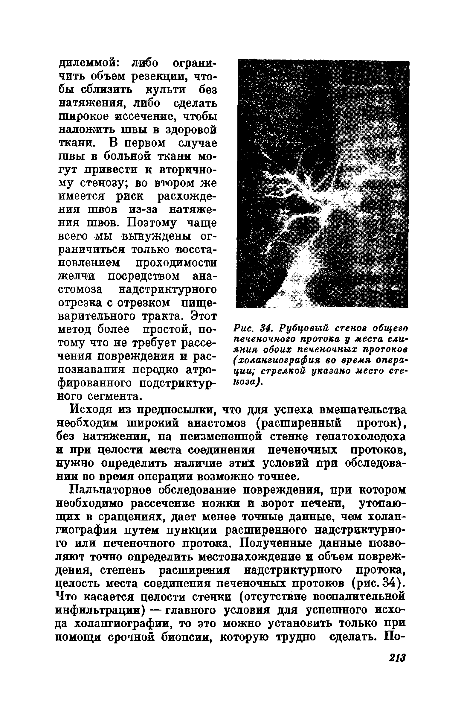 Рис. 34. Рубцовый стеноз общего печеночного протока у места слияния обоих печеночных протоков (холангиография во время операции стрелкой указано место стеноза).