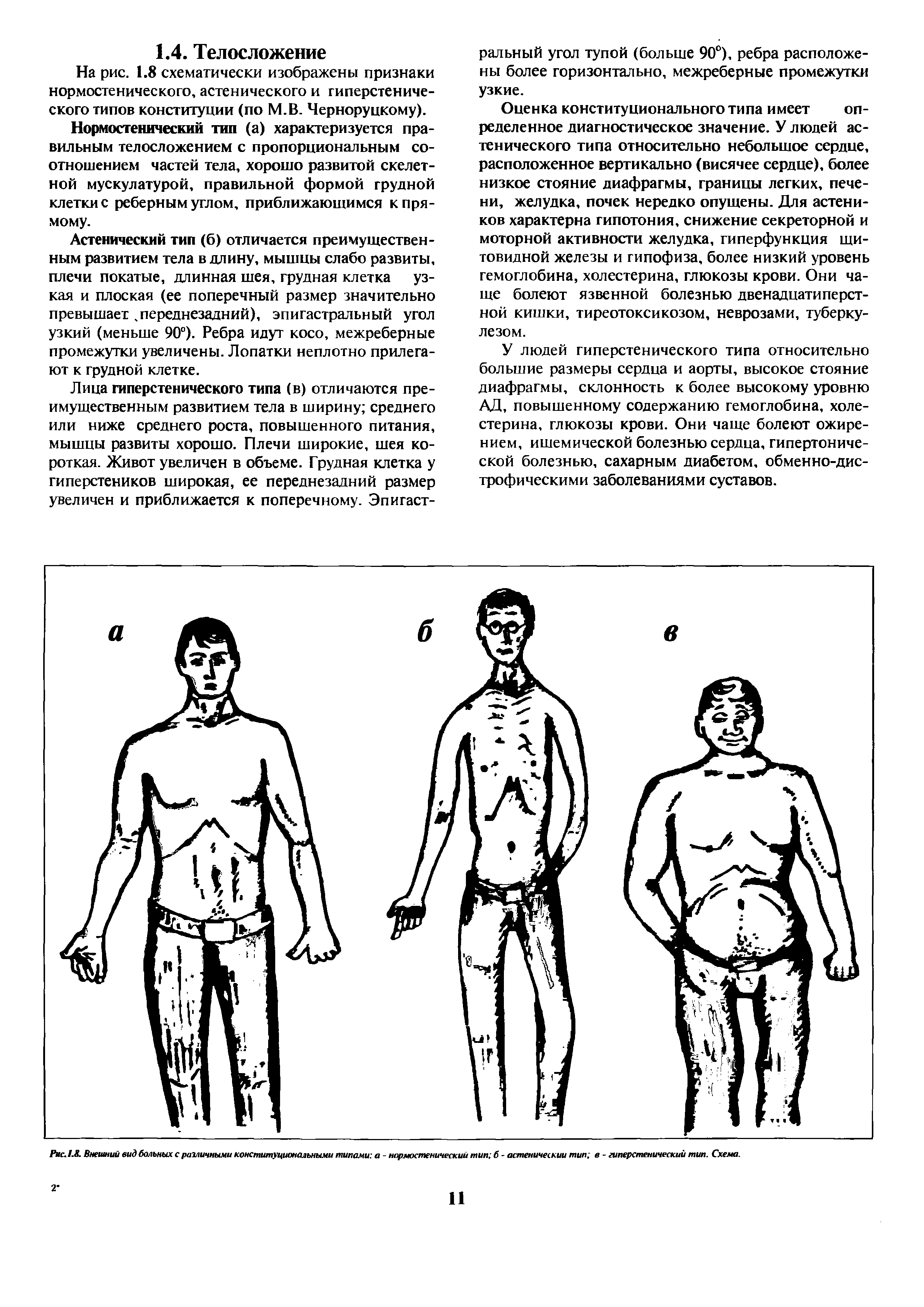 Рис. 1.. Внешний вид больных с различными конституциональными типами а - нормостенический тип б - астенический тип в - гиперстенический тип. Схема.