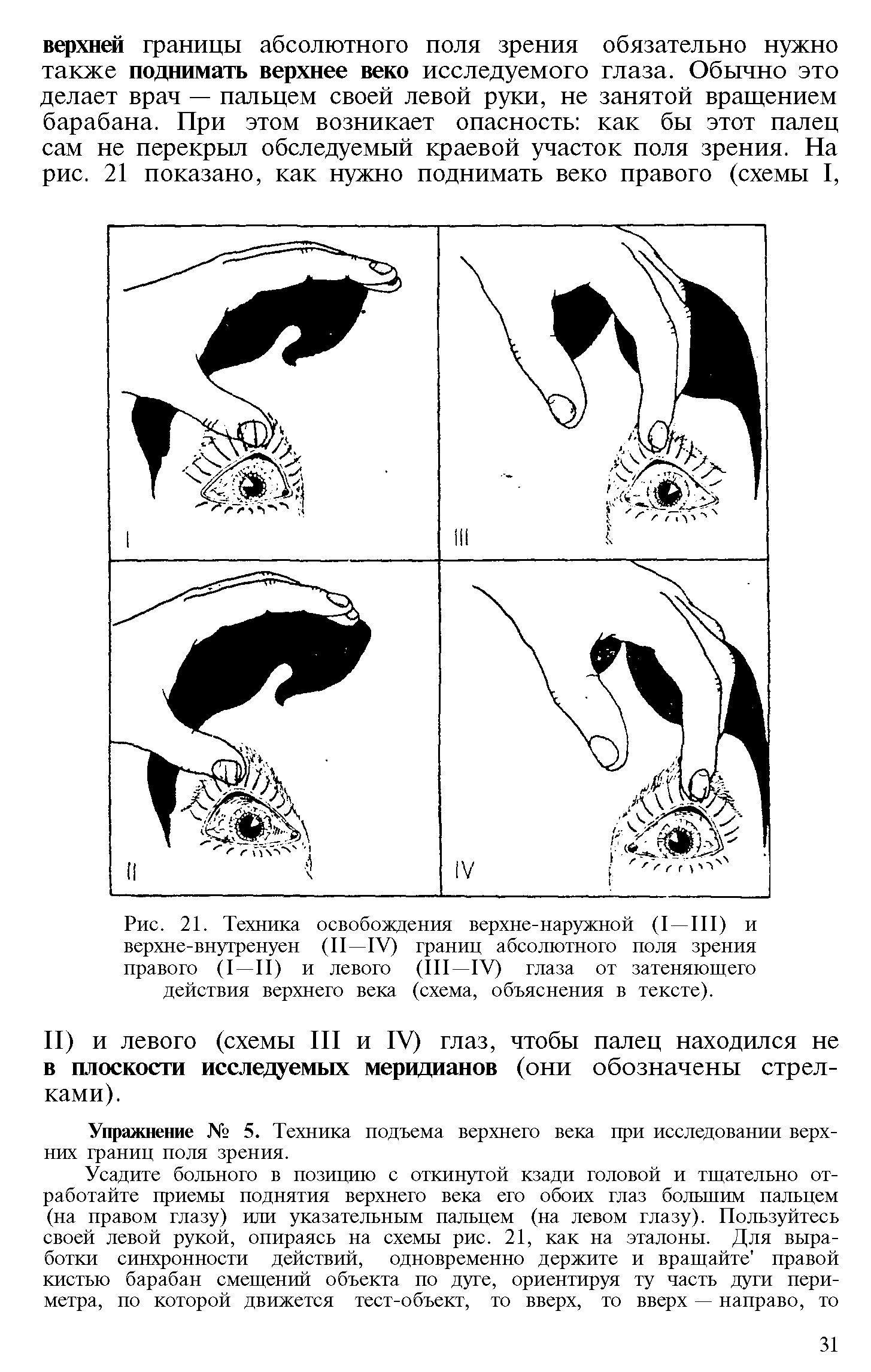 Рис. 21. Техника освобождения верхне-наружной (I —III) и верхне-внутренуен (II—IV) границ абсолютного поля зрения правого (I—II) и левого (III—IV) глаза от затеняющего действия верхнего века (схема, объяснения в тексте).
