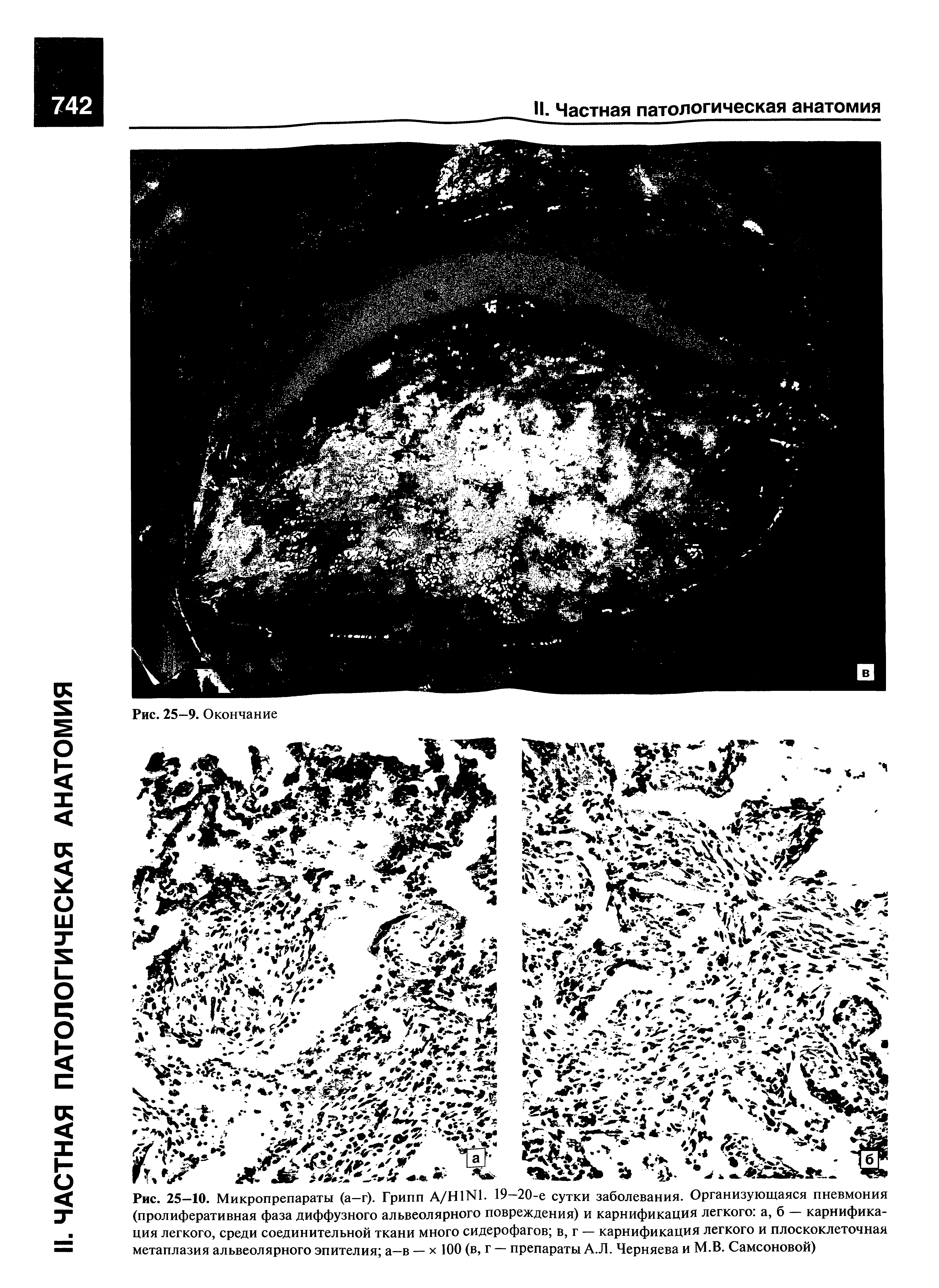 Рис. 25—10. Микропрепараты (а—г). Грипп А/Н1Ы1. 19—20-е сутки заболевания. Организующаяся пневмония (пролиферативная фаза диффузного альвеолярного повреждения) и карнификация легкого а, б — карнифика-ция легкого, среди соединительной ткани много сидерофагов в, г — карнификация легкого и плоскоклеточная метаплазия альвеолярного эпителия а-в — х 100 (в, г — препараты А.Л. Черняева и М.В. Самсоновой)...