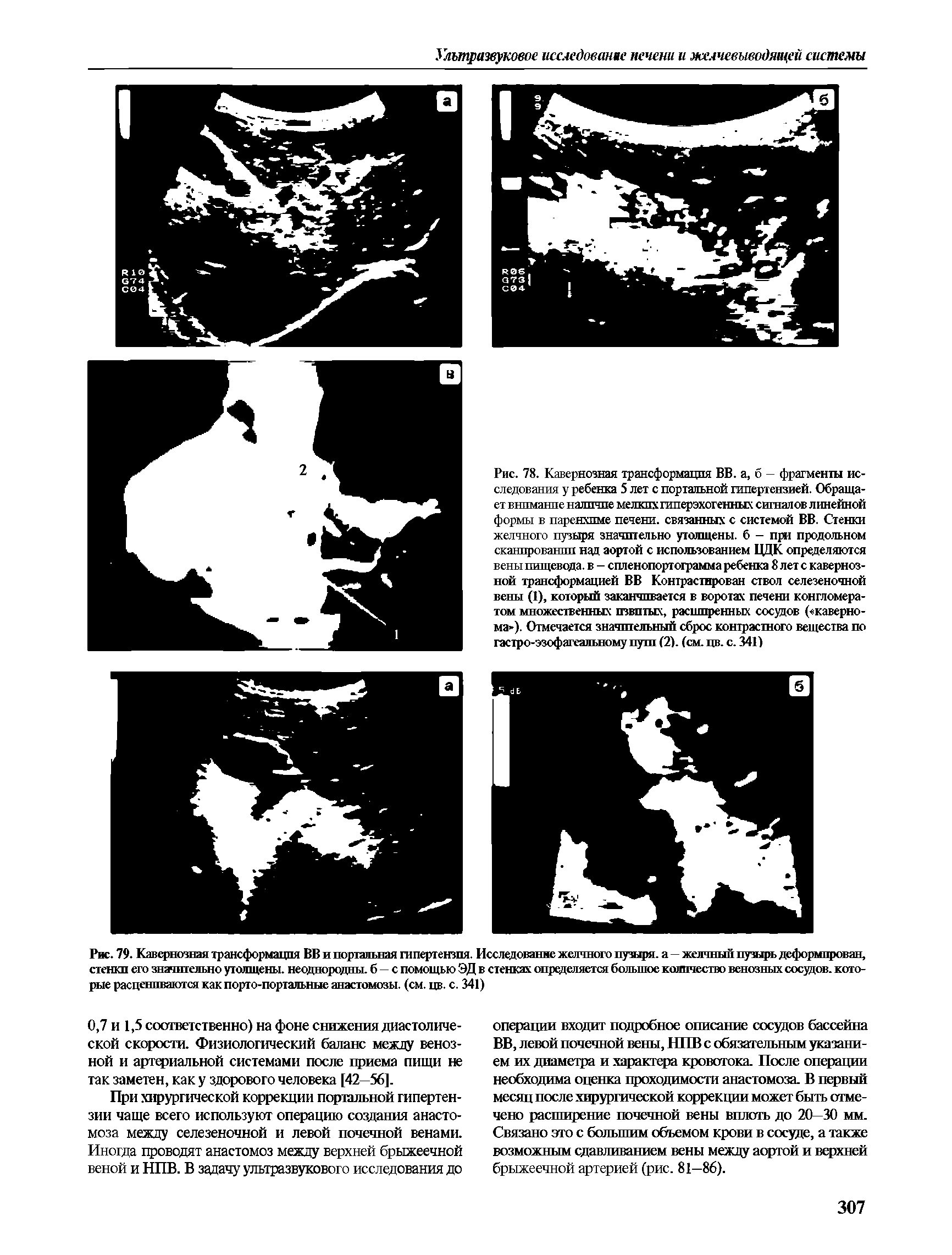 Рис. 79. Кавернозная трансформация ВВ и портальная гипертензия. Исследование желчного пузыря, а—желчный пузырь деформирован, стенки его значительно утолщены, неоднородны, б — с помощью ЭД в стенках определяется большое количество венозных сосудов, которые расцениваются как порто-портальные анастомозы, (см. цв. с. 341)...