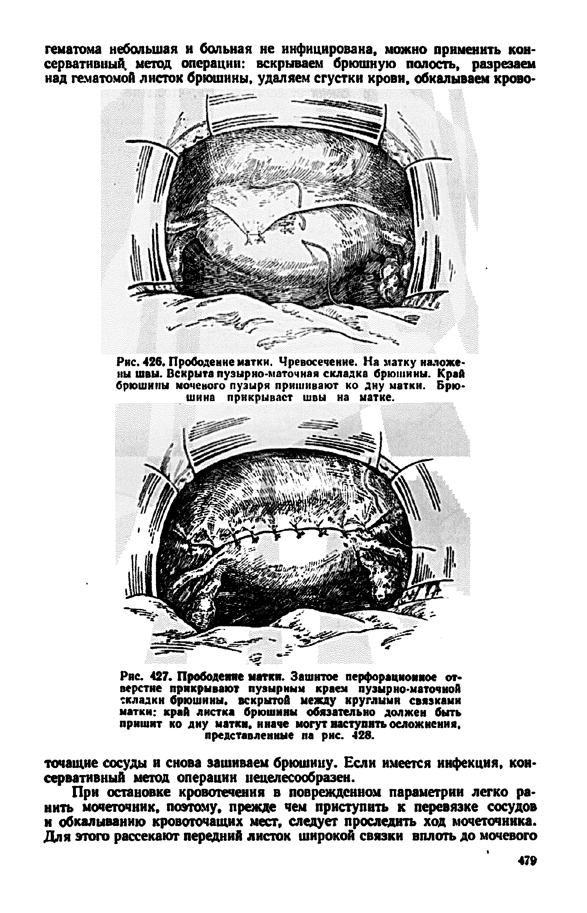 Рис. 426. Прободение матки. Чревосечение. На матку наложены швы. Вскрыта пузырно-маточная складка брюшины. Край брюшины мочевого пузыря пришивают ко дну матки. Брюшина прикрывает швы на матке.