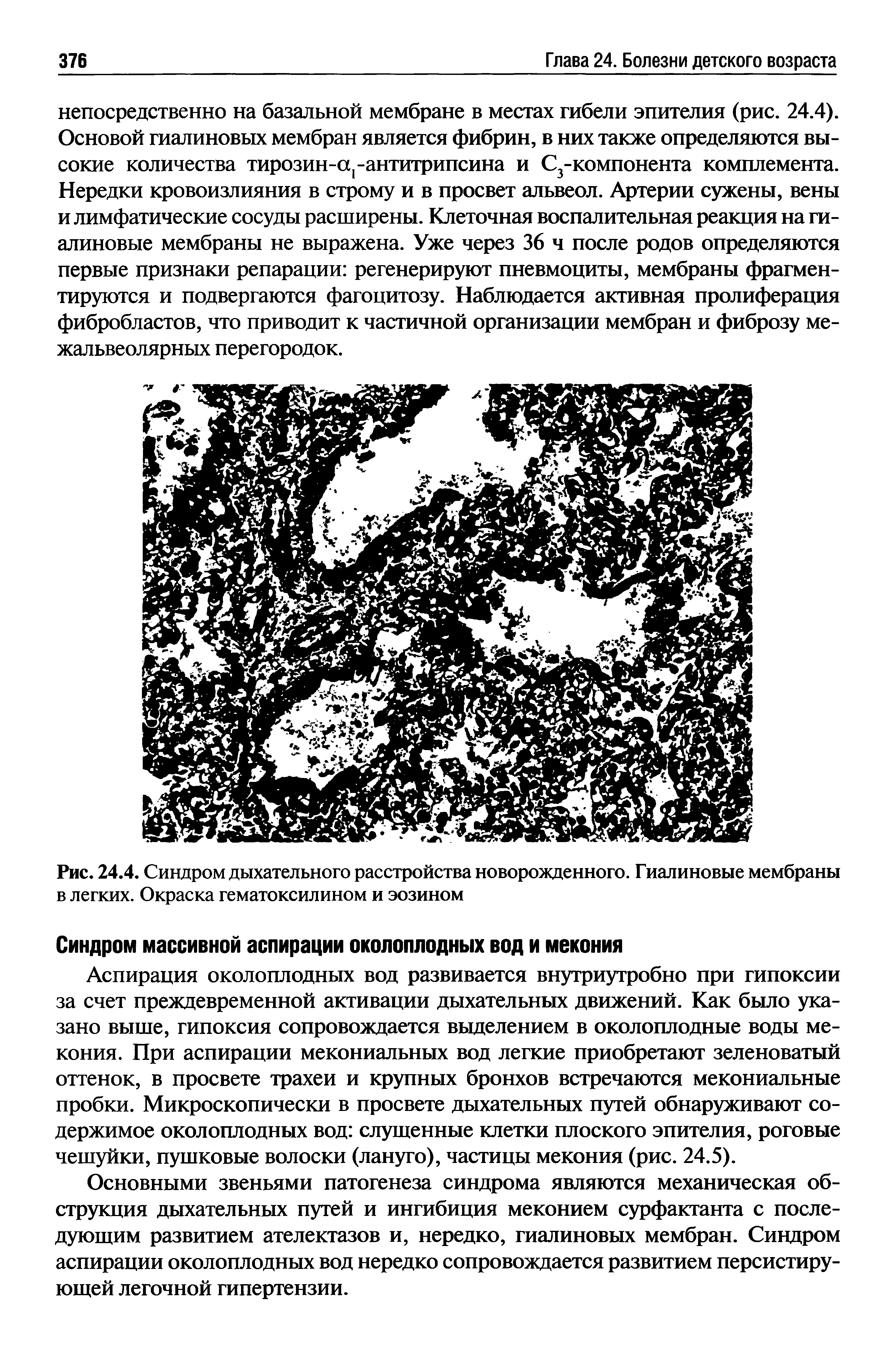 Рис. 24.4. Синдром дыхательного расстройства новорожденного. Гиалиновые мембраны в легких. Окраска гематоксилином и эозином...