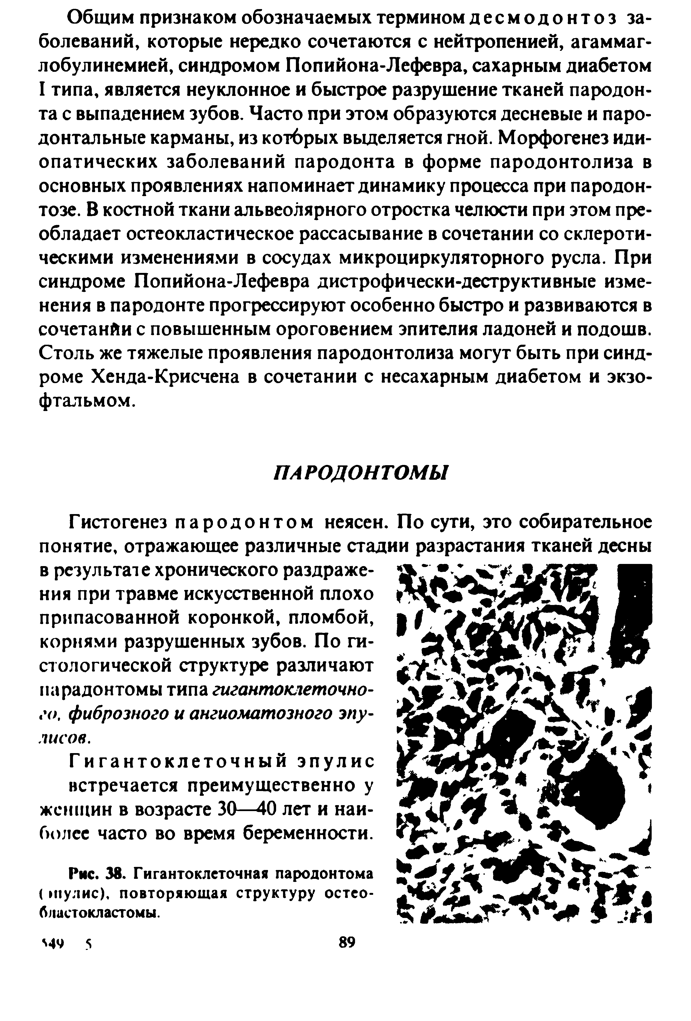 Рис. 38. Гигантоклеточная пародонтома ( пулис), повторяющая структуру остеобластокластомы.