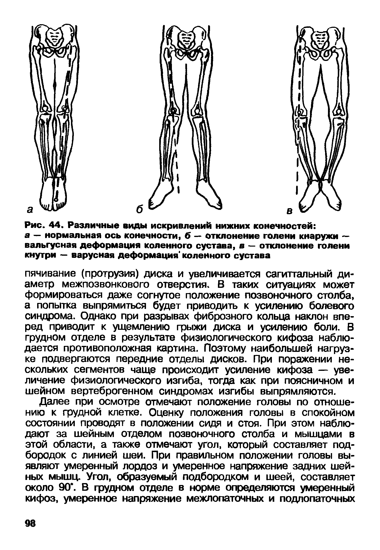 Рис. 44. Различные виды искривлений нижних конечностей а — нормальная ось конечности, б — отклонение голени кнаружи — вальгусная деформация коленного сустава, в — отклонение голени кнутри — варусная деформация коленного сустава...