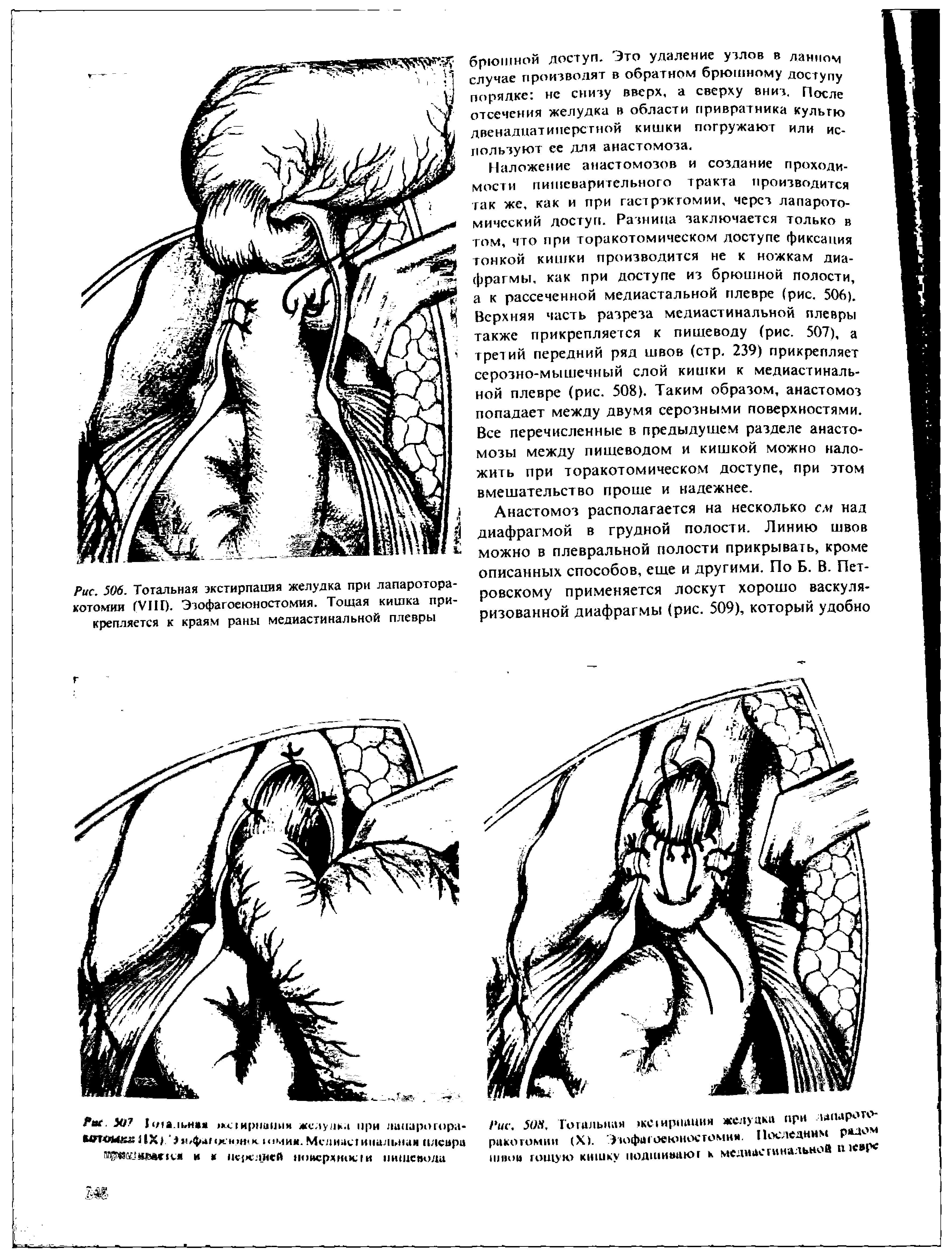 Рис. 50И. Тотальная жС1ирнаиия желудка при ракотимин (X). Эзофагоеюностомия. Последним Р плюй тощую кишку нодшиаают к мсдиасгинально...