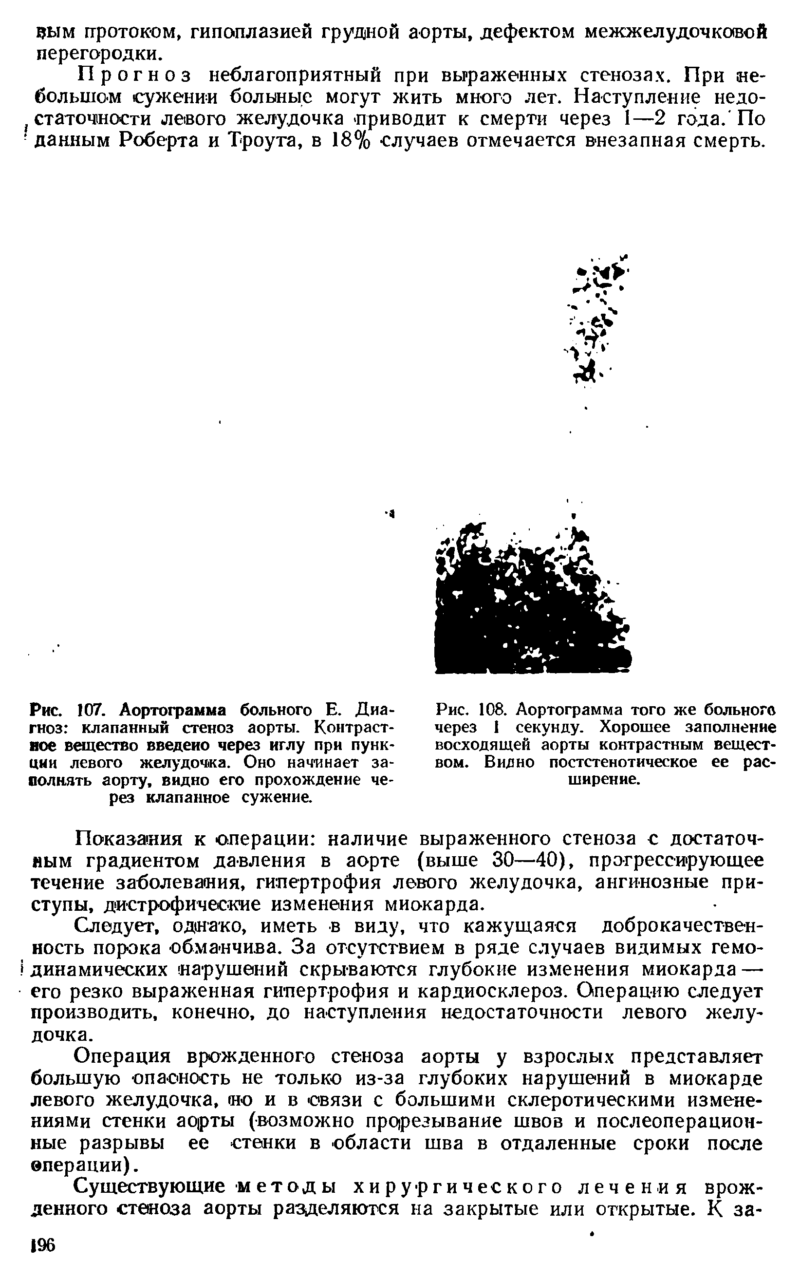 Рис. 107. Аортограмма больного Е. Диагноз клапанный стеноз аорты. Контрастное вещество введено через иглу при пункции левого желудочка. Оно начинает заполнять аорту, видно его прохождение через клапанное сужение.