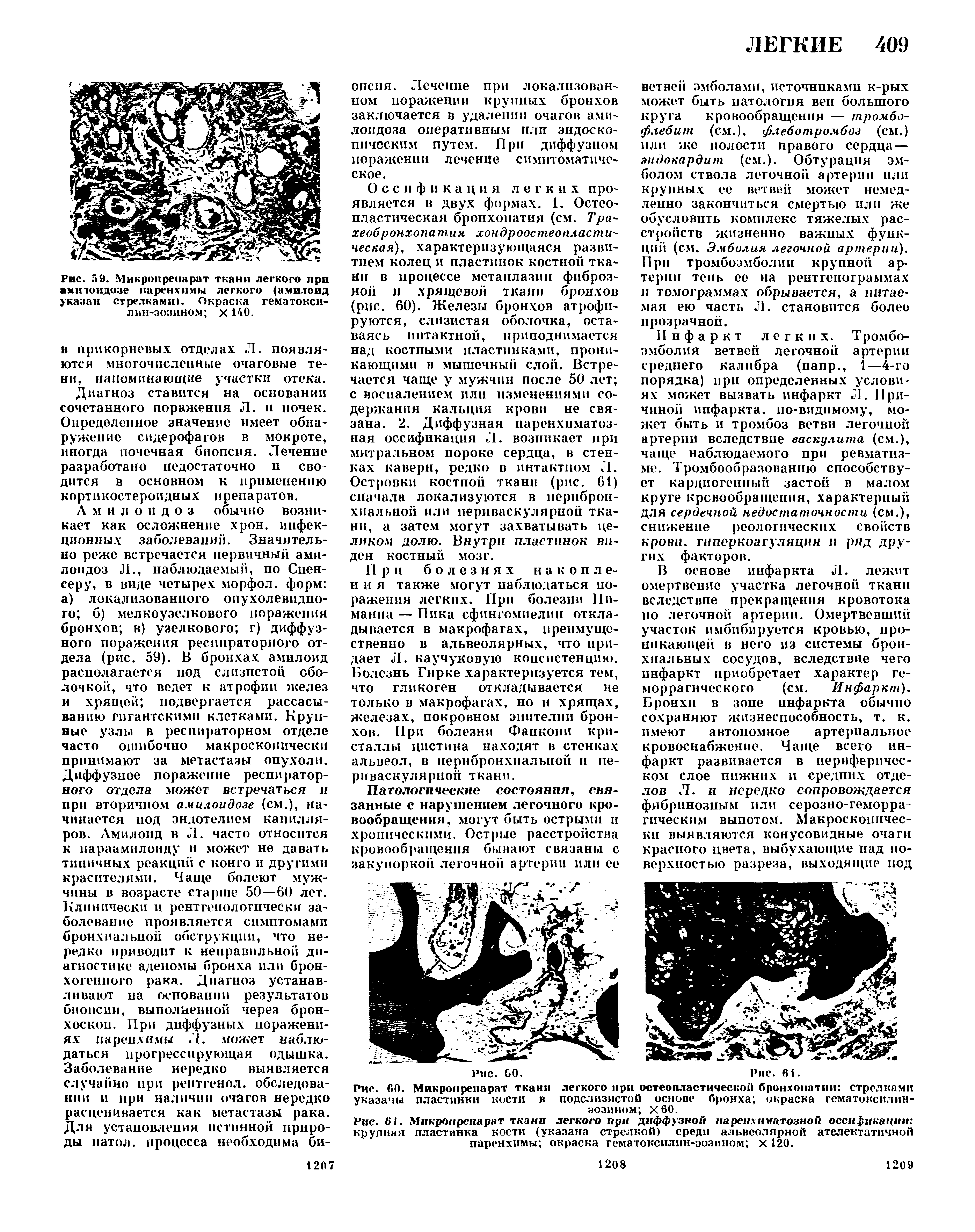 Рис. 61. Микропрепарат ткани легкого при дифф узко Гг паренхиматозной осснриканнн крупная пластинка кости (указана стрелкой) среди альвеолярной ателектатичной паренхимы окраска гсматоксилшьэозином X 120.