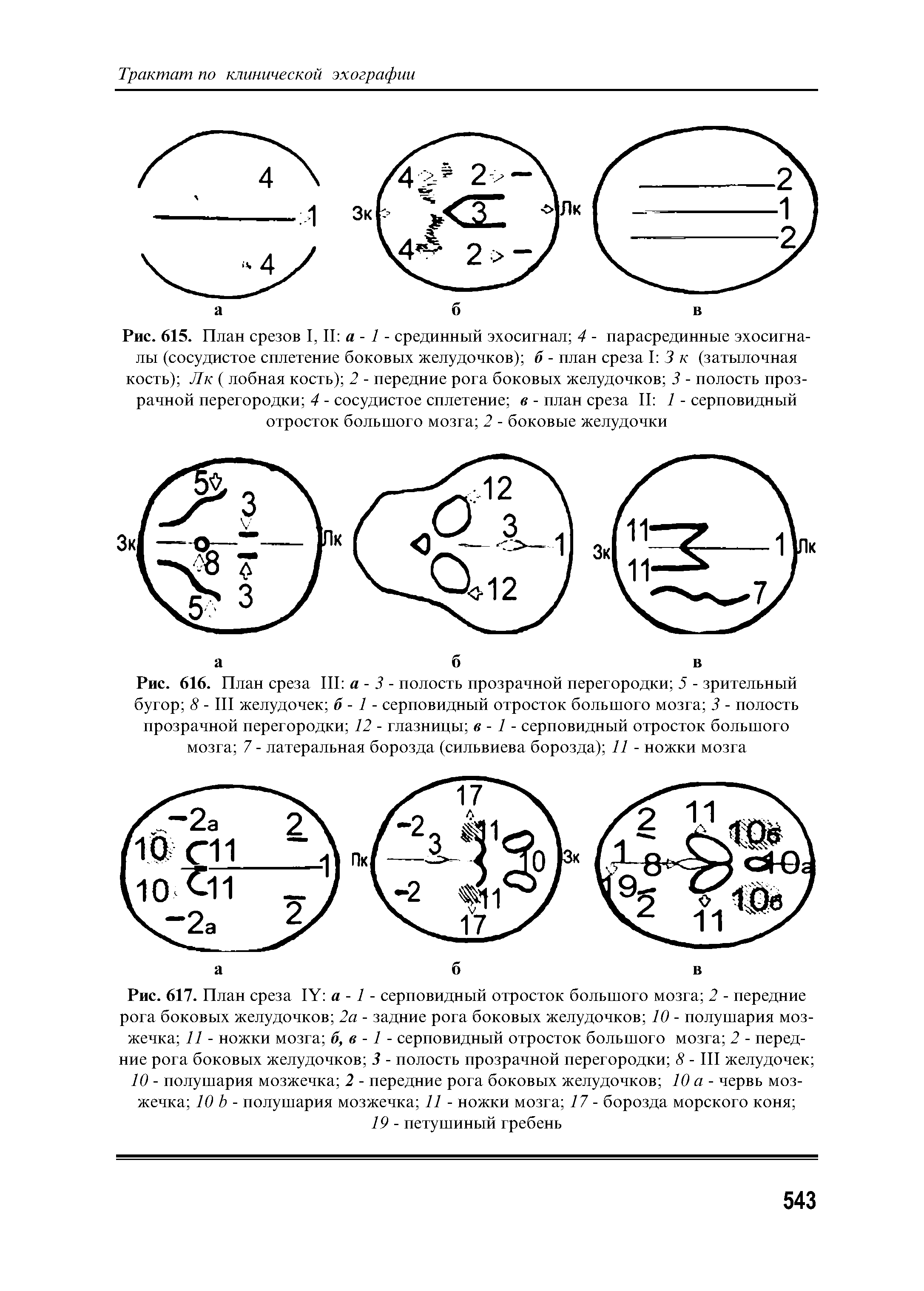 Рис. 615. План срезов I, II а - 1 - срединный эхосигнал 4 - парасрединные эхосигна-лы (сосудистое сплетение боковых желудочков) б - план среза I 3 к (затылочная кость) Лк ( лобная кость) 2 - передние рога боковых желудочков 3 - полость прозрачной перегородки 4 - сосудистое сплетение в - план среза II 1 - серповидный отросток большого мозга 2 - боковые желудочки...